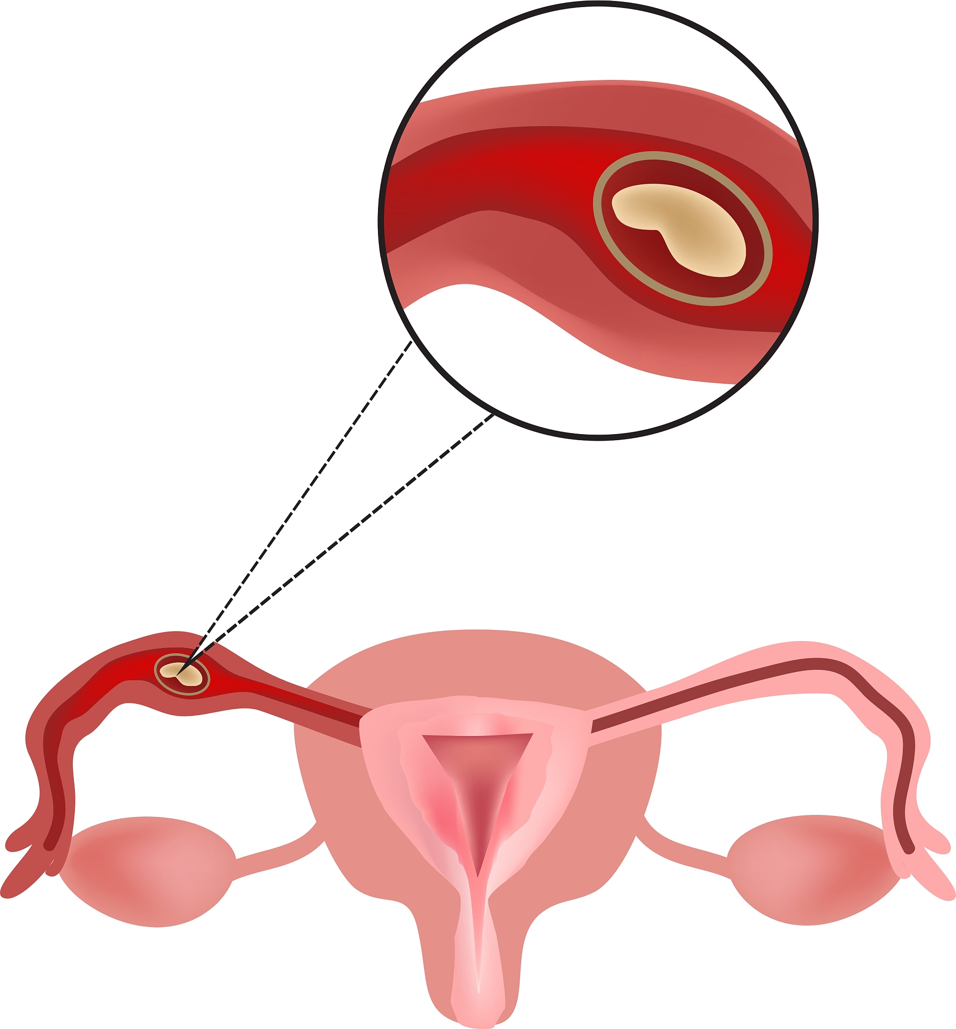 左侧输卵管妊娠破裂伴急性失血性贫血：如何维持体温正常？