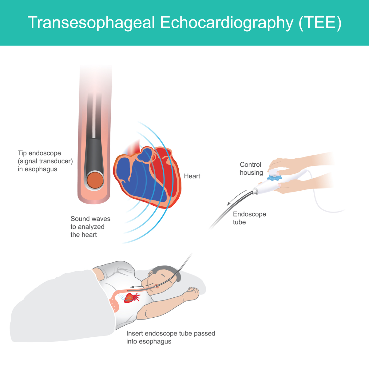 经皮血管成形术 (PTA)：治疗血液透析患者动静脉内瘘狭窄的有效方法