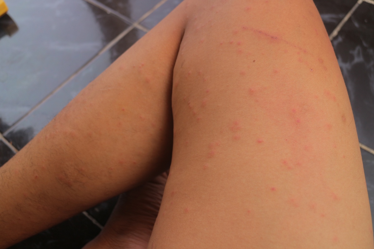 身上起疙瘩很痒越来越多？可能是这几种原因！