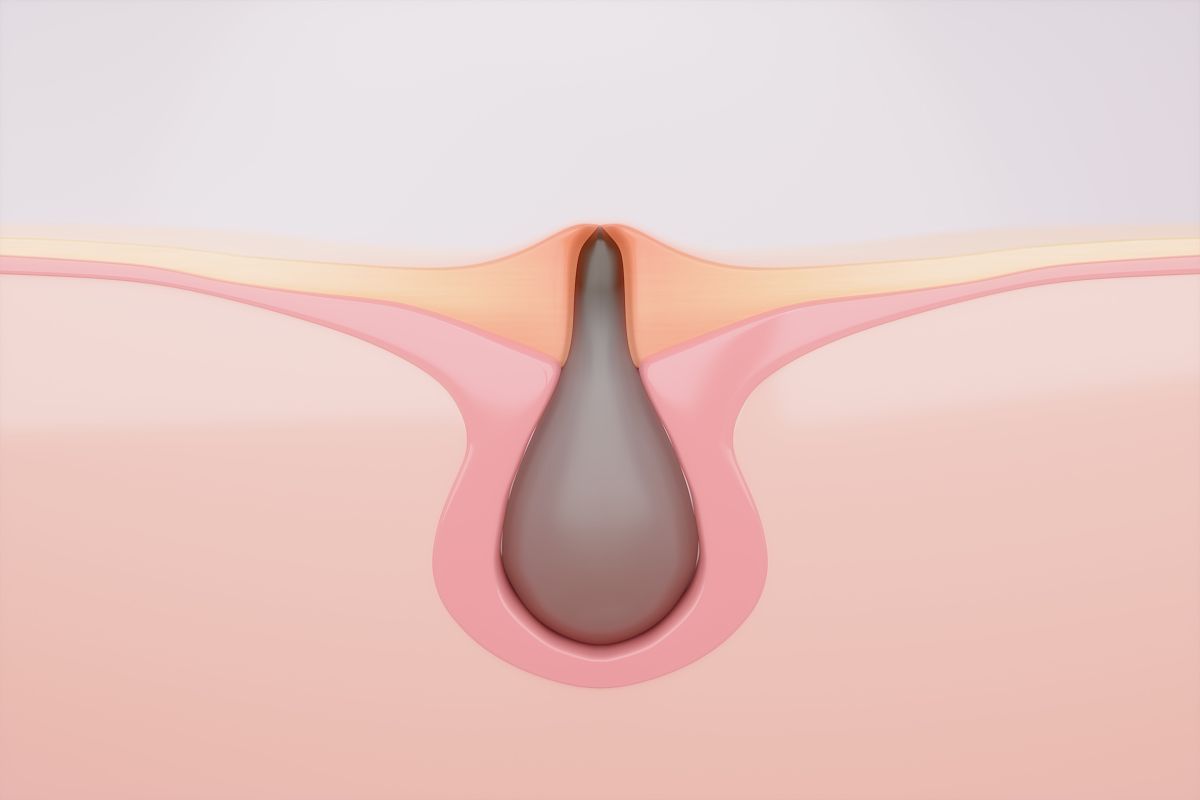 罗麦牌番红素软胶囊可以治疗黑头吗？