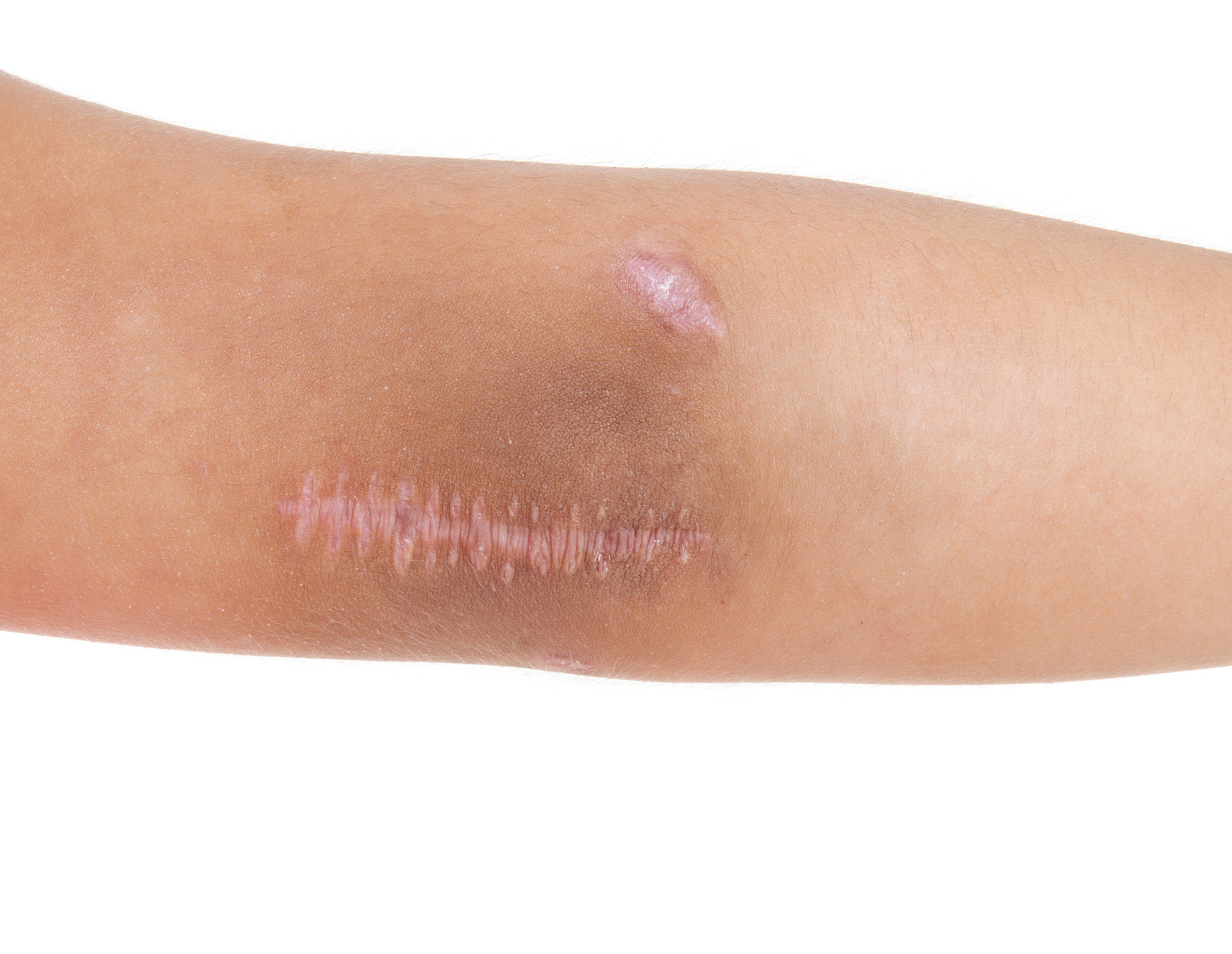 伤口好了后皮肤疤痕皮肤凸起