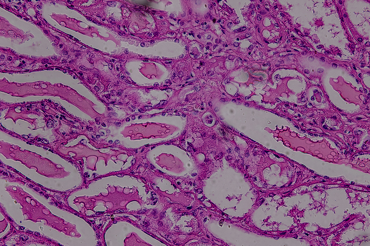 溃疡性结肠炎 (UC) 和克罗恩病 (CD): IBD 的两种主要形式
