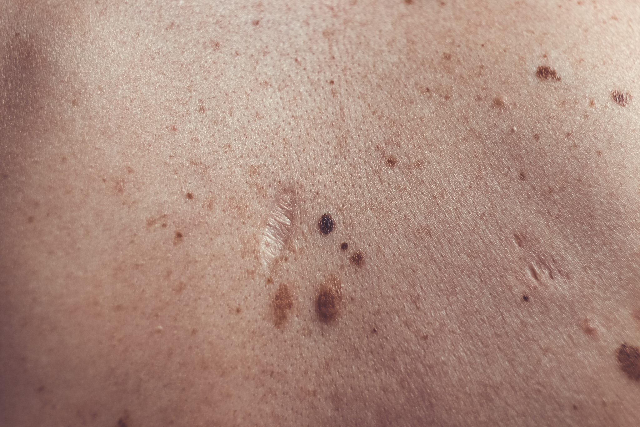melanocytic nevus, some of them dyplastic or atypical, on a cauc