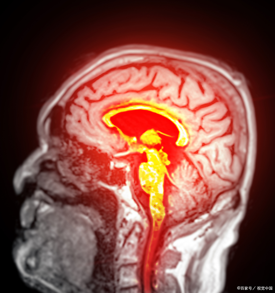 脑挫裂伤：隐藏在头颅内的定时炸弹