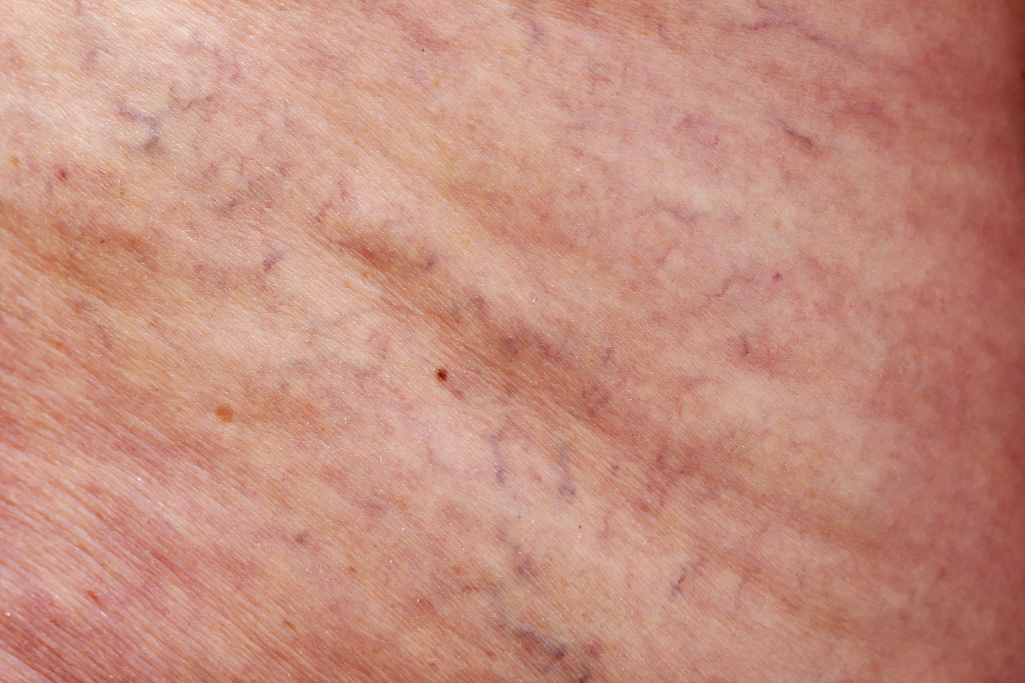 精索静脉曲张症状 - 常见症状及治疗建议