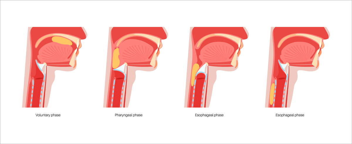 食管癌并发食管胃支气管瘘：护理指南与注意事项