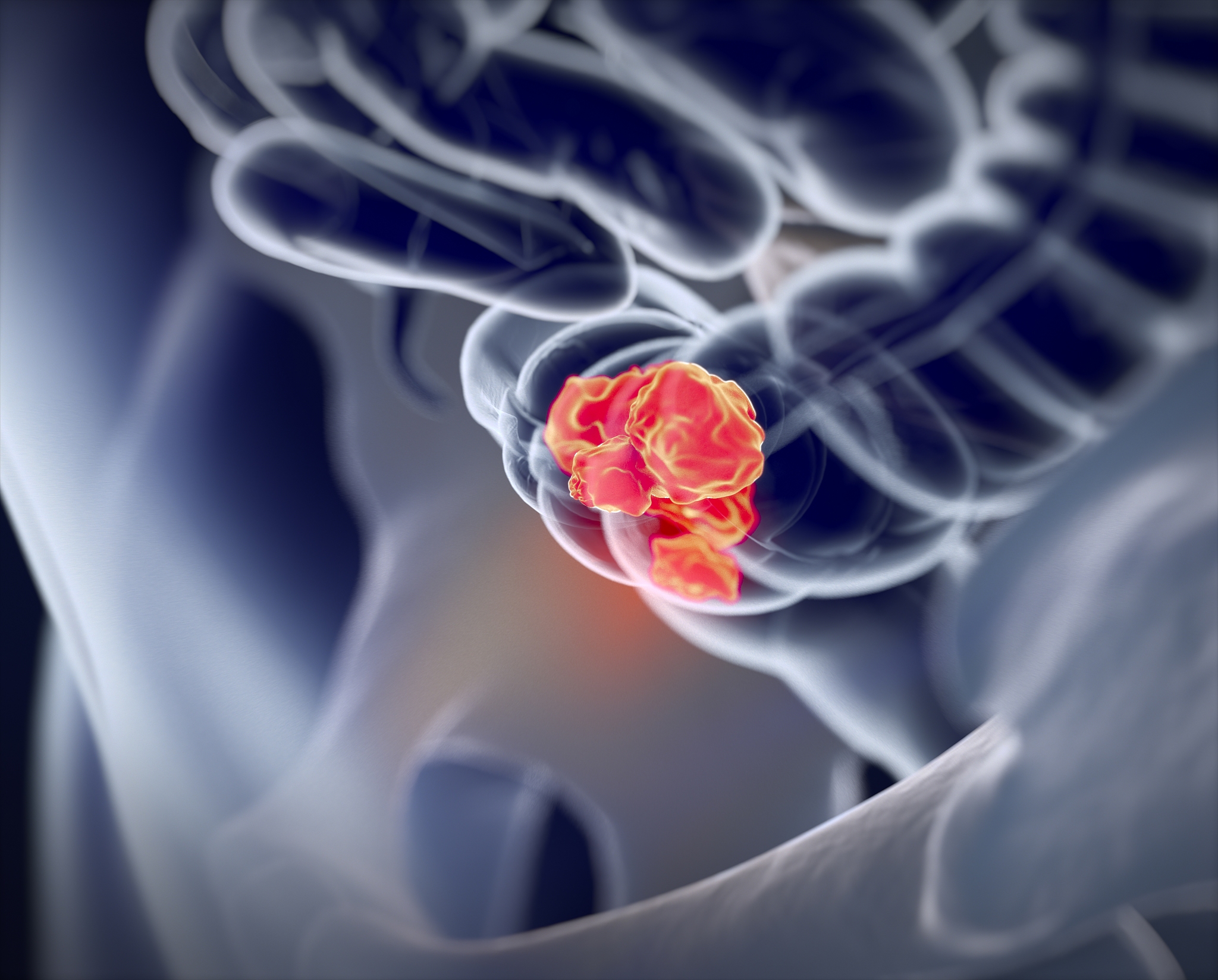 作为本科论文论文题目是结直肠癌造口患者家庭回避癌症沟通现状调查及影响因素分析可以帮我写一份论文提纲嘛？不要这种结果、讨论、设计之类的提纲