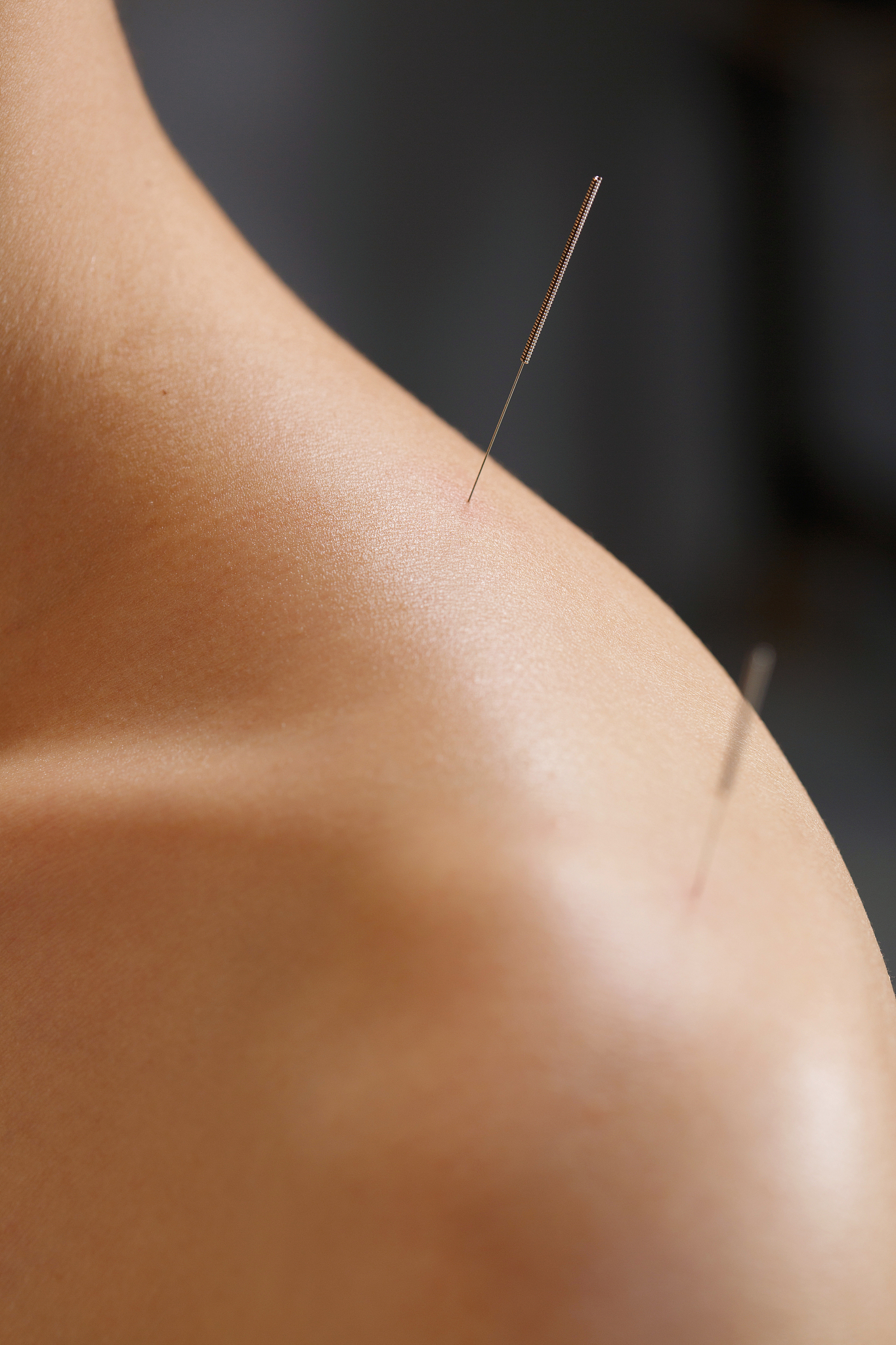 针灸治疗慢性下腰痛文献综述要求有绪论、相关方法、研究结果、展望文章中应包括以下内容：一、绪论慢性下腰痛是指持续时间超过12周的下腰部疼痛是一种常见的病症严重影响患者的生活质量。目前传统的药物治疗和物理治疗已经不能完全满足患者的需求因此针灸治疗作为一种传统的中医治疗方法受到越来越多的关注。本文旨在综述针灸治疗慢性下腰痛的研究进展以期为临床提供一定的参考。二、相关方法本文采用文献综述的方法通过检索国内