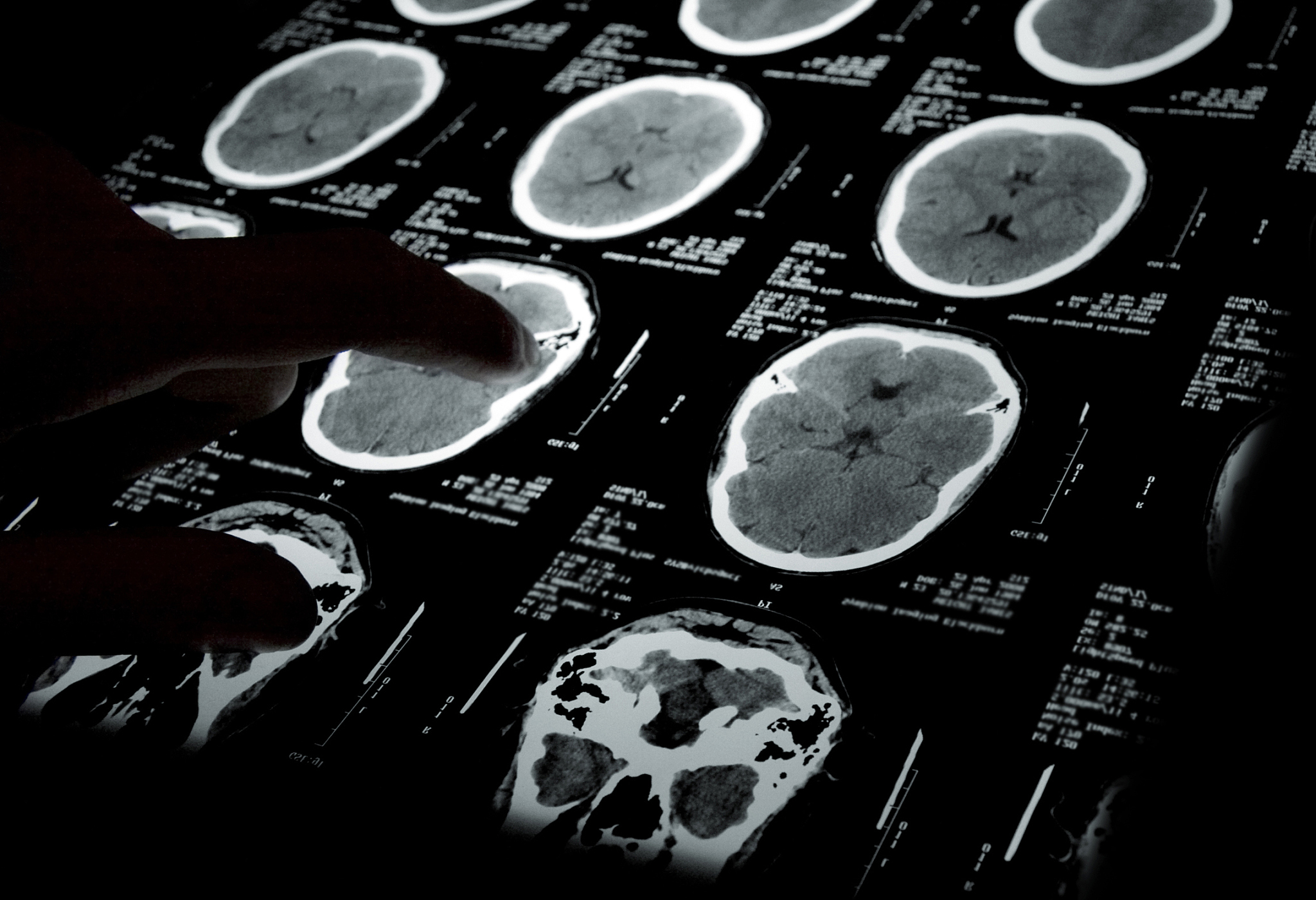 我的论文是《腺泡样软组织肉瘤的CT、MR特征分析》请在中国知网检索相关文献写出文章的结果部分不少于3000个汉字。