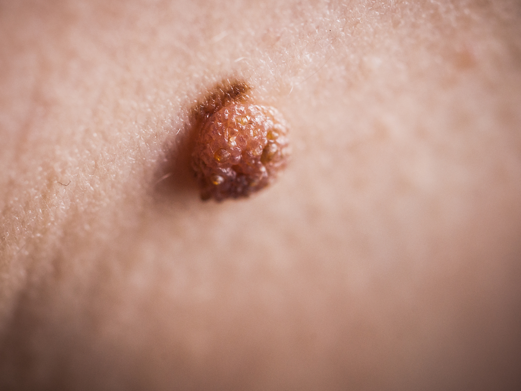 unrecognizable person having dark fibroma.