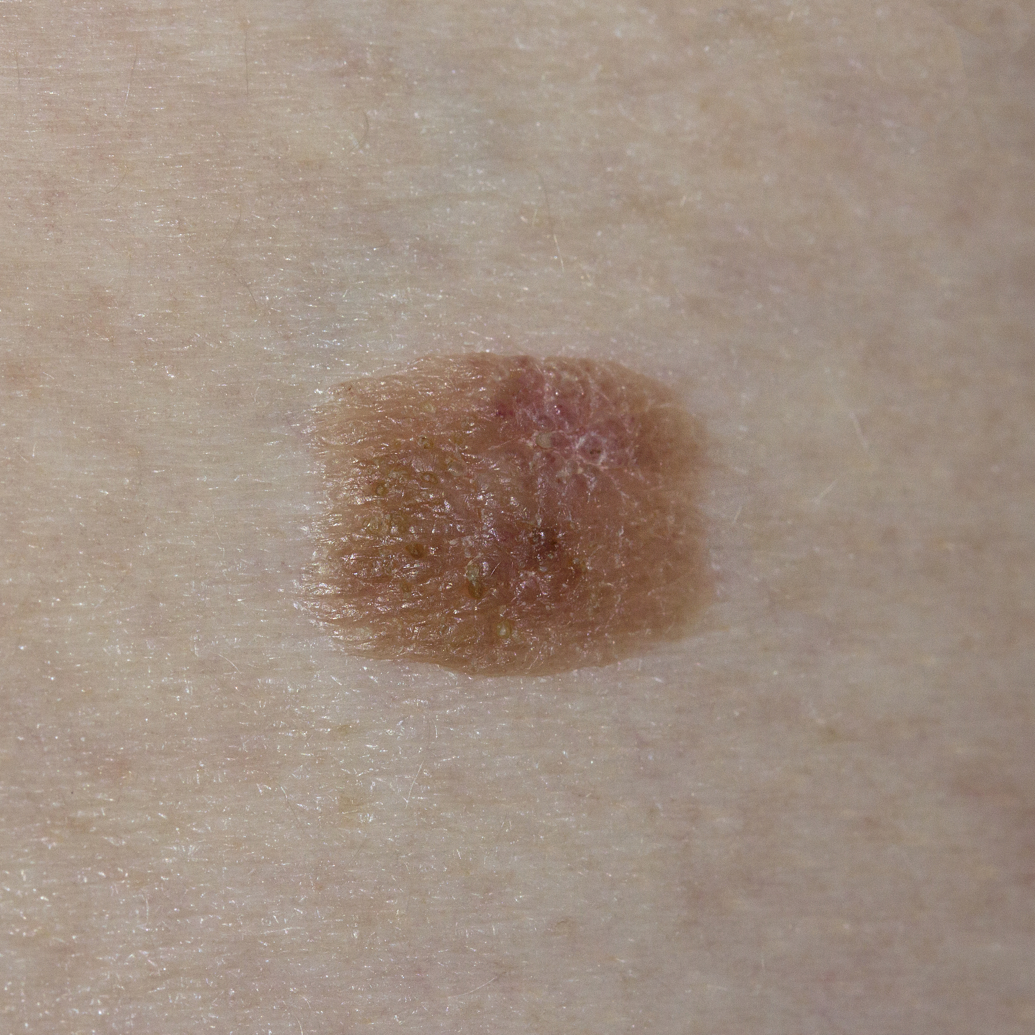 新长出的痣正常吗？可能原因及就医建议