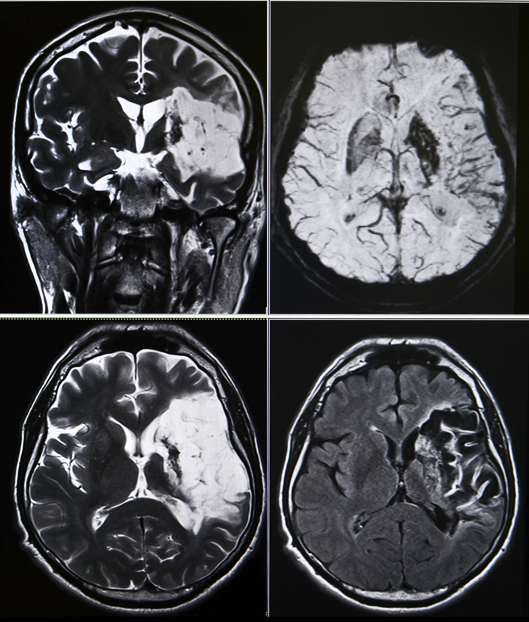 右侧尾状核头急性腔隙性脑梗死：MRI证实与患者神经精神症状关联