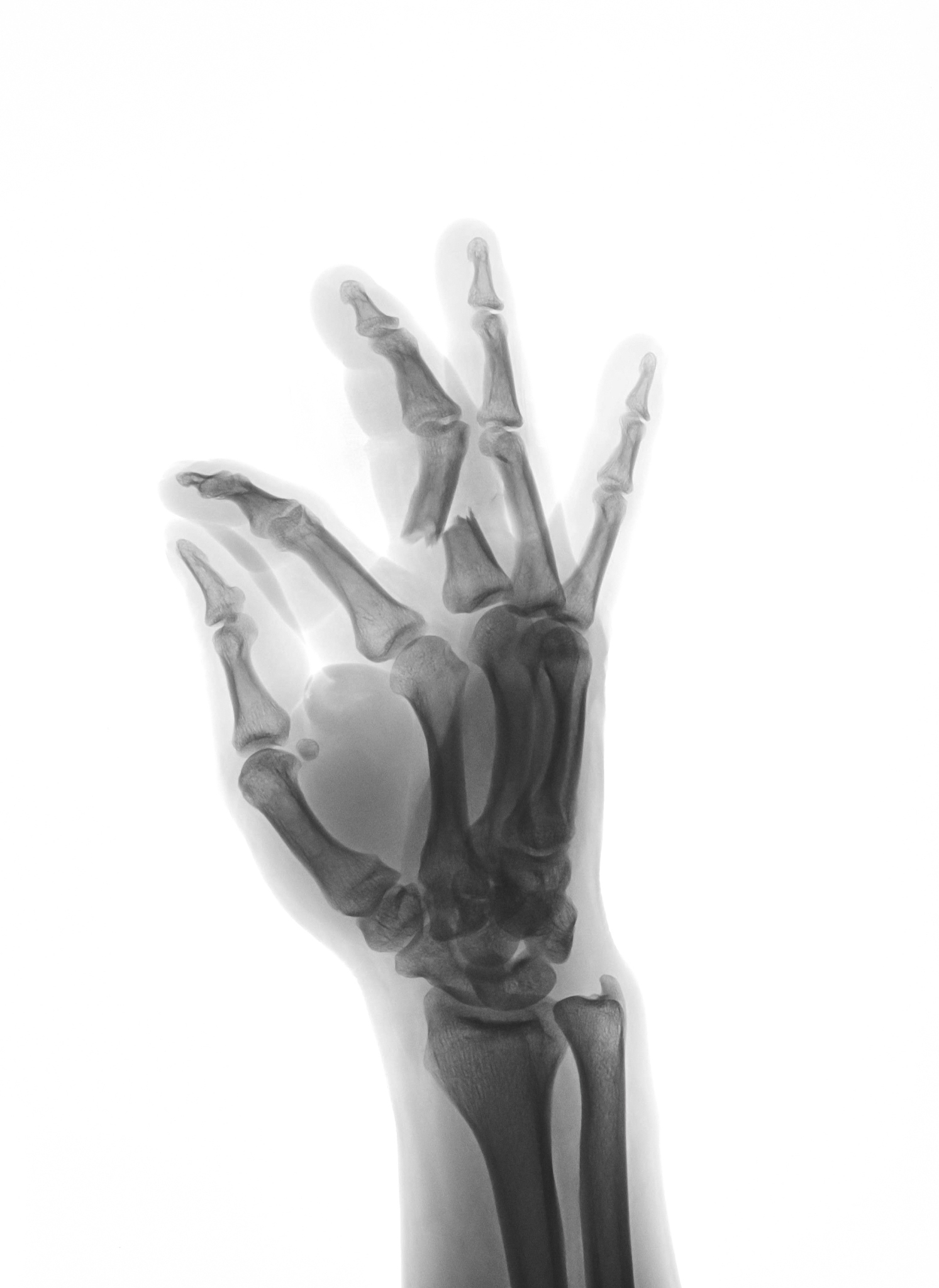 小指骨：人体骨骼解剖 - pinky mcp 解释