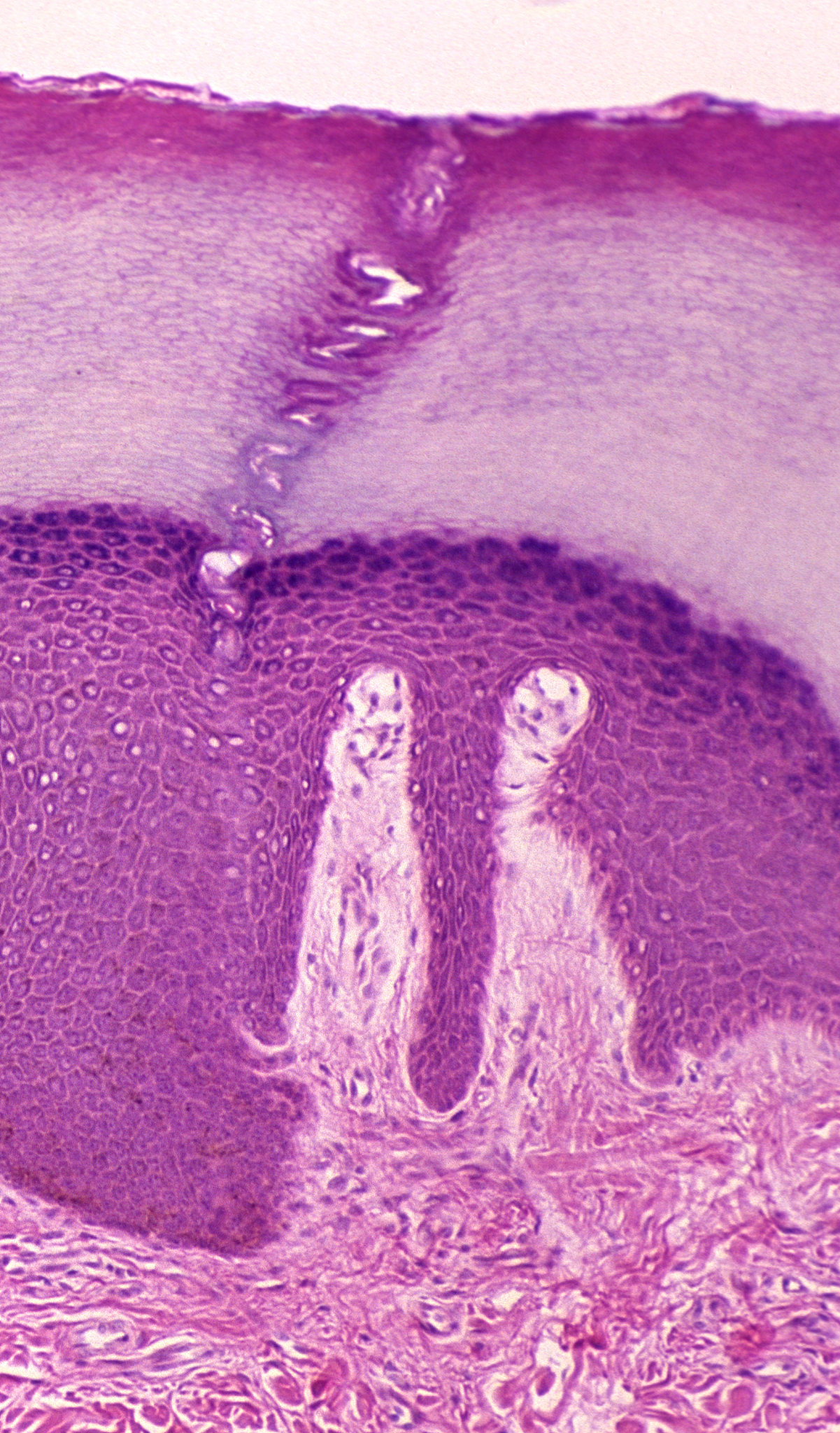 耳屎屎怎么产生的