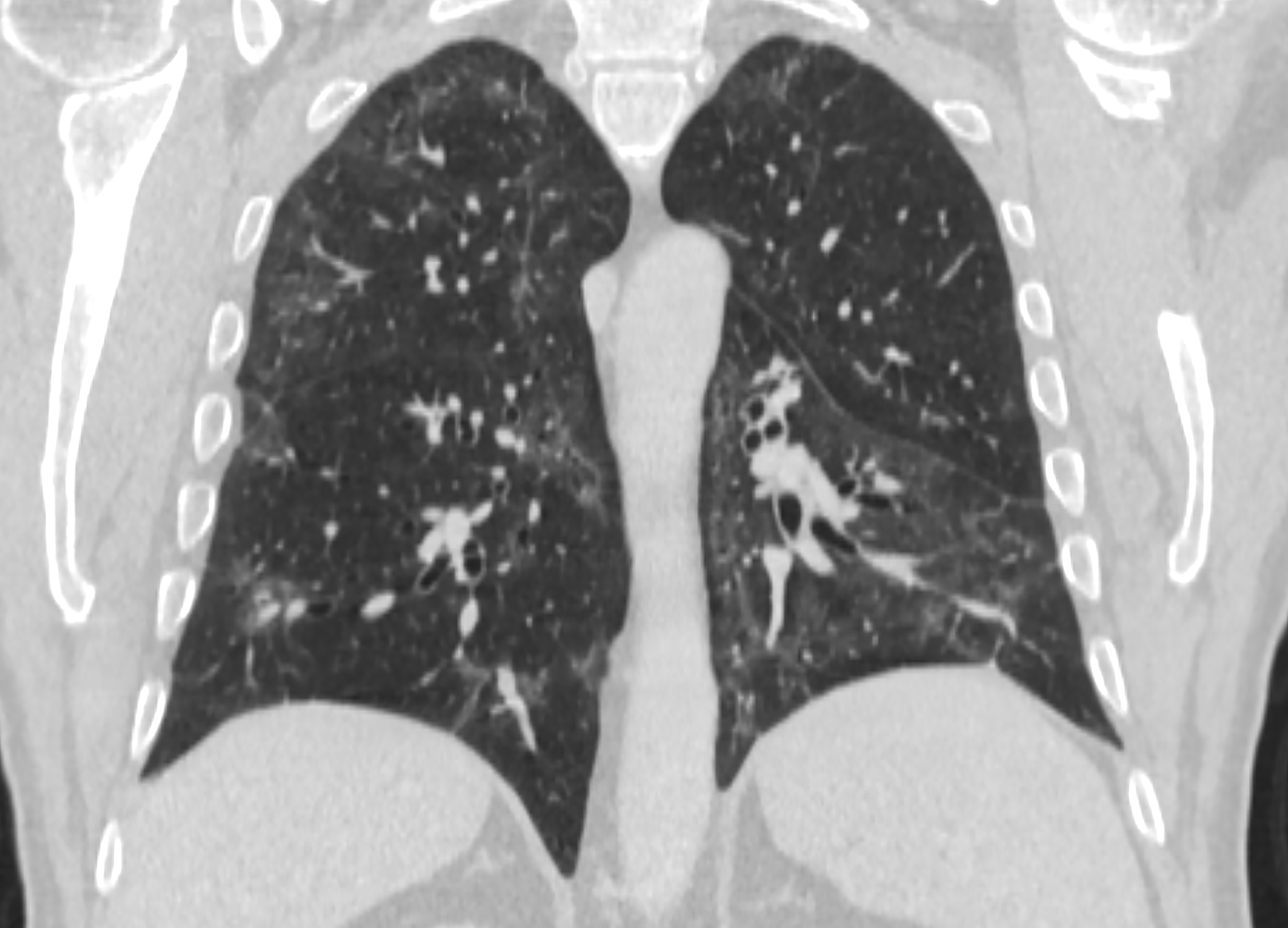 右肺腺癌术后呼吸衰竭伴肌肉脓肿感染护理指南