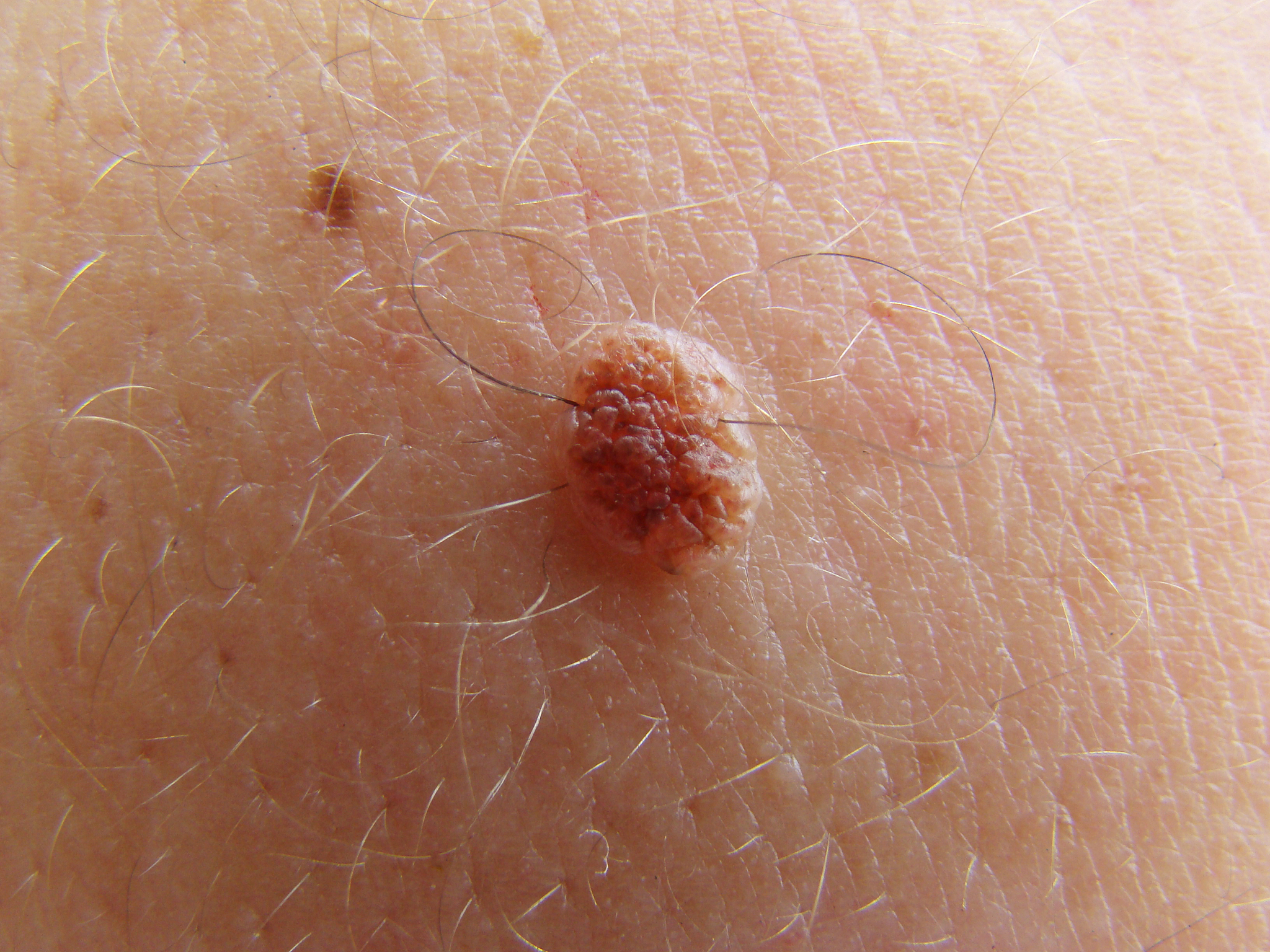 nevus