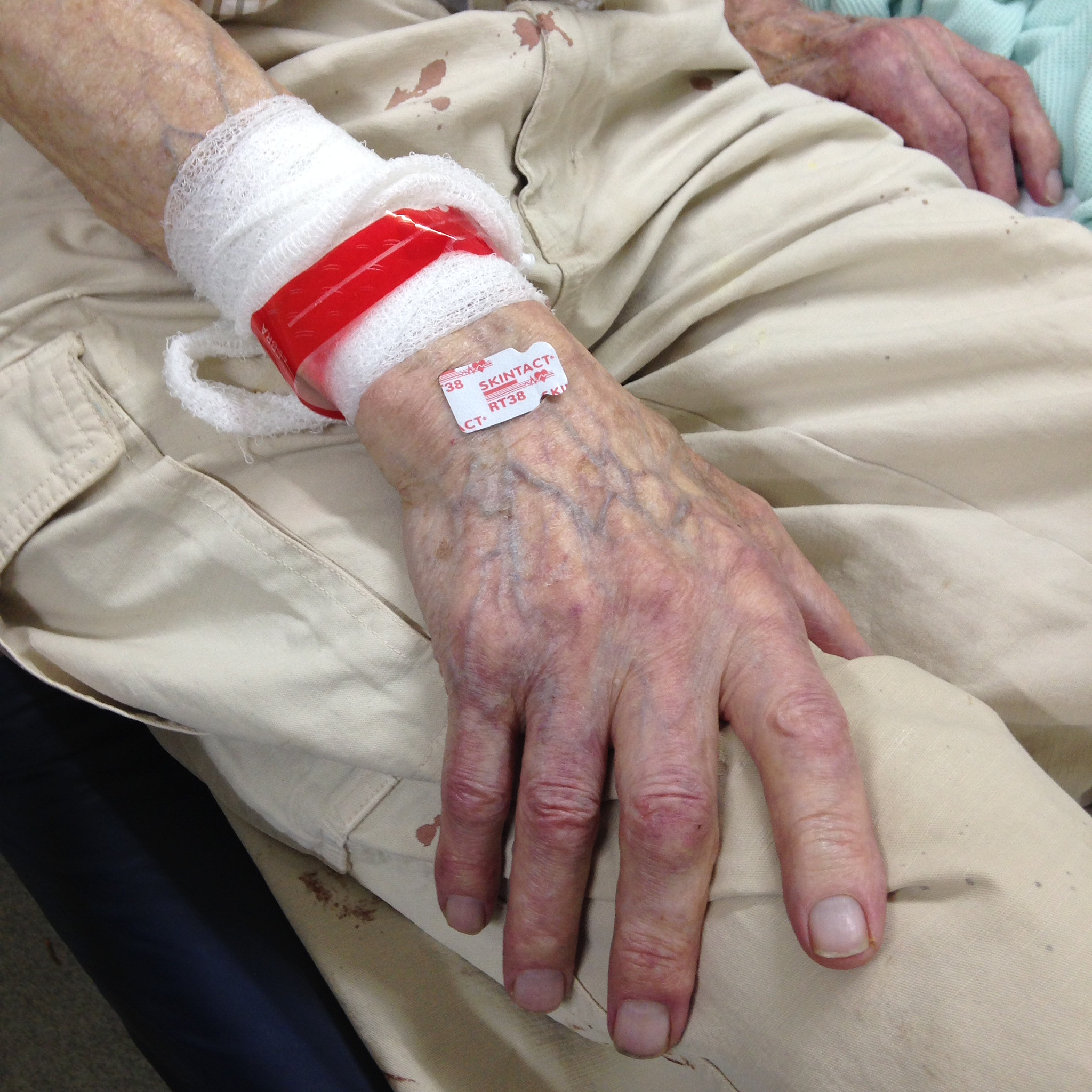 老婆做饭烫伤怎么办？如何安慰和处理？