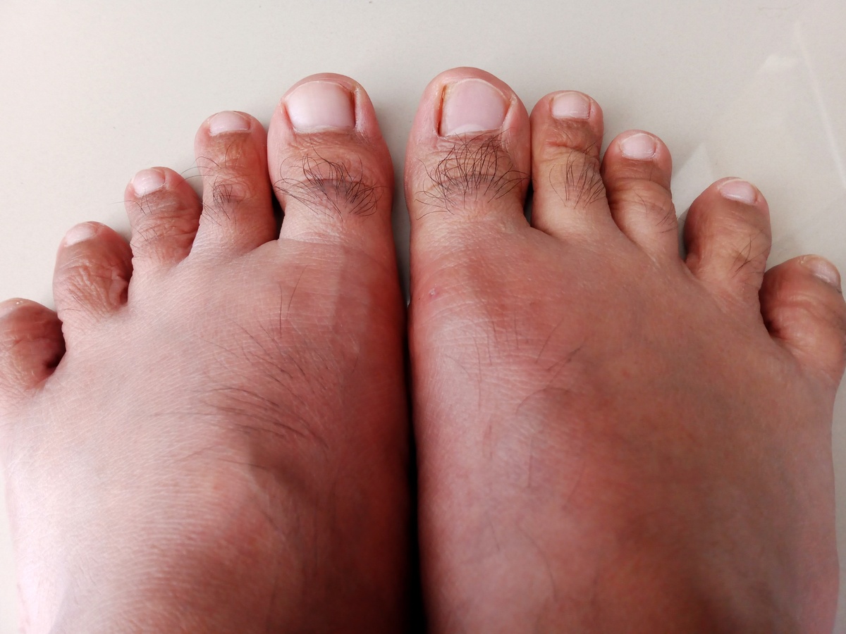 脚后跟肿了怎么办？常见原因及应对方法