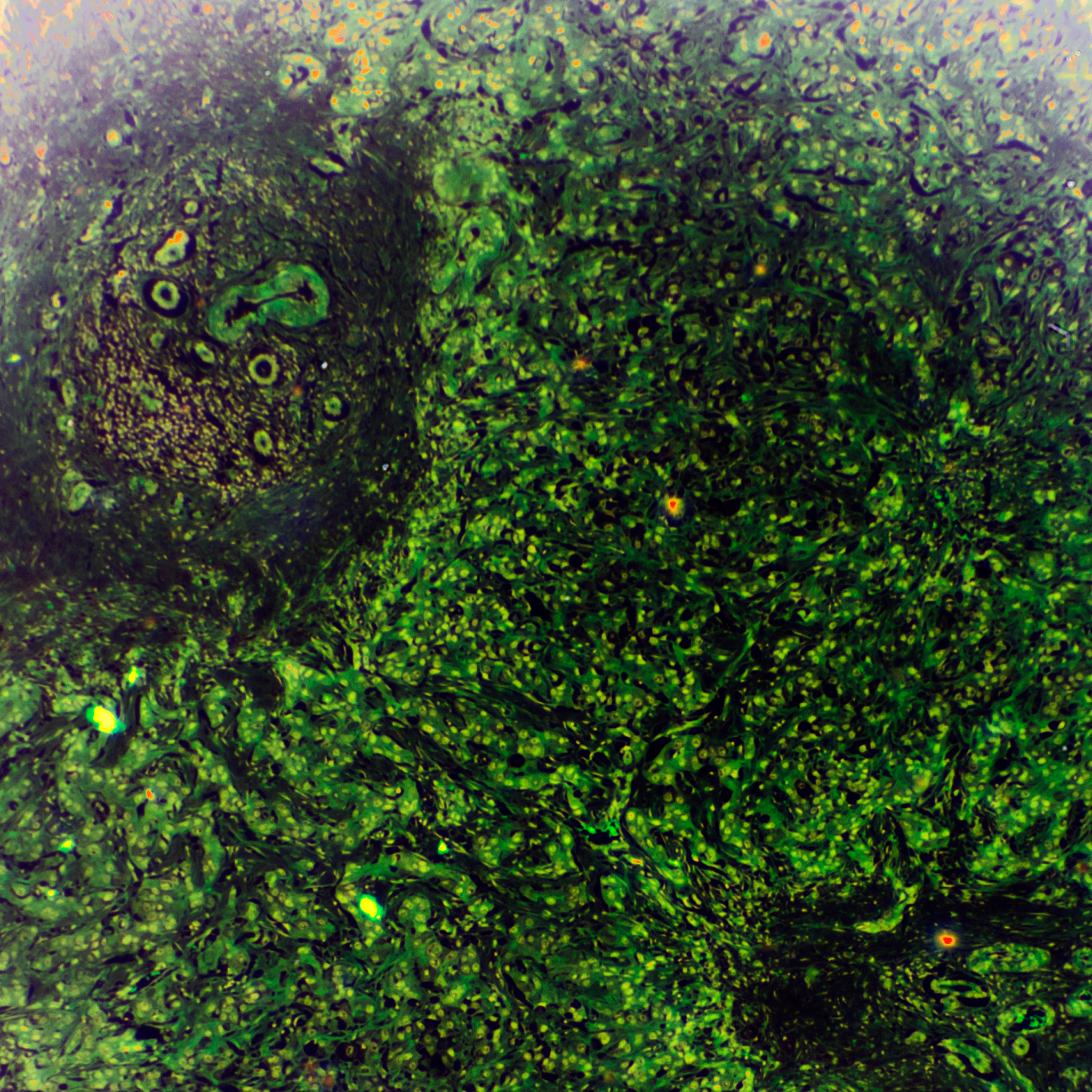Sonazoid ACR CEUS LI-RADS vs. Modified CEUS LI-RADS: Which is Better for HCC Diagnosis?