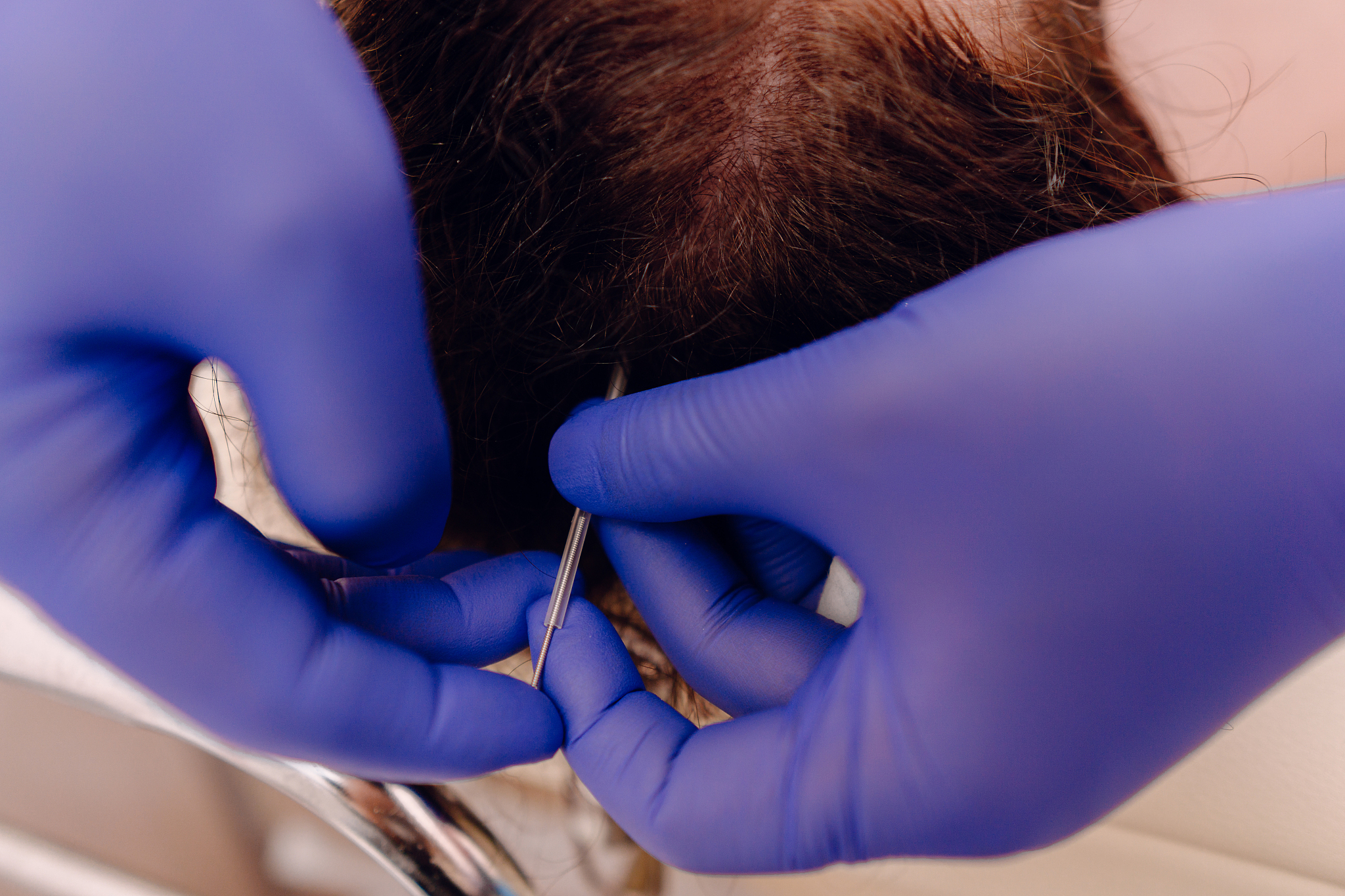 针灸治疗慢性下腰痛中文核心期刊文献概述慢性下腰痛是一种常见的临床症状针灸作为一种传统的中医治疗方法被广泛应用于慢性下腰痛的治疗。本文概述了一些中文核心期刊文献关于针灸治疗慢性下腰痛的研究。1《中华中医药学刊》发表了一篇名为针刺加艾灸治疗慢性下腰痛的临床疗效观察的研究。该研究通过对60例慢性下腰痛患者的治疗观察发现针刺加艾灸可显著缓解慢性下腰痛的症状并且没有明显的不良反应。2《中国针灸》发表了一篇名