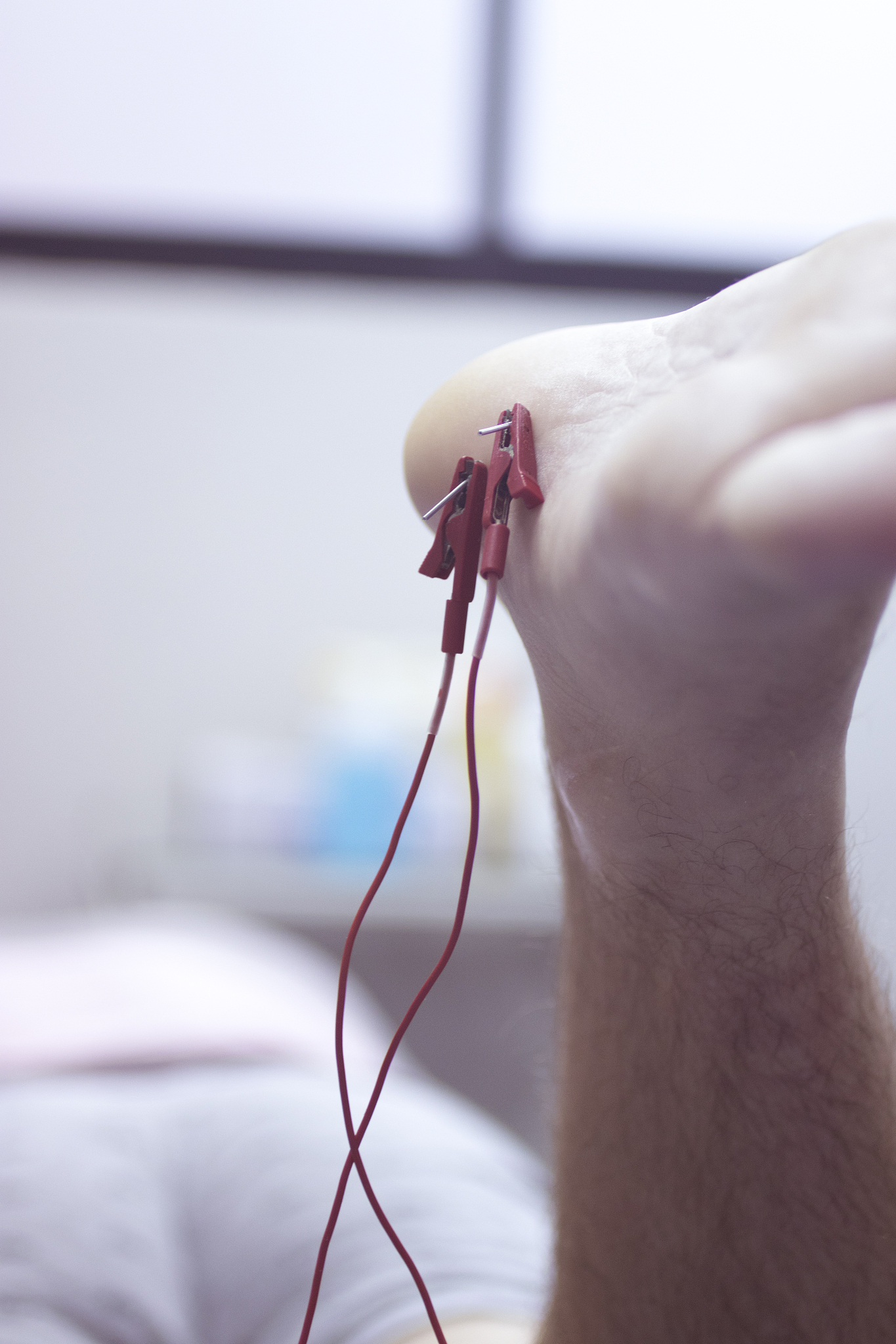 close-up of acupuncture needles in leg