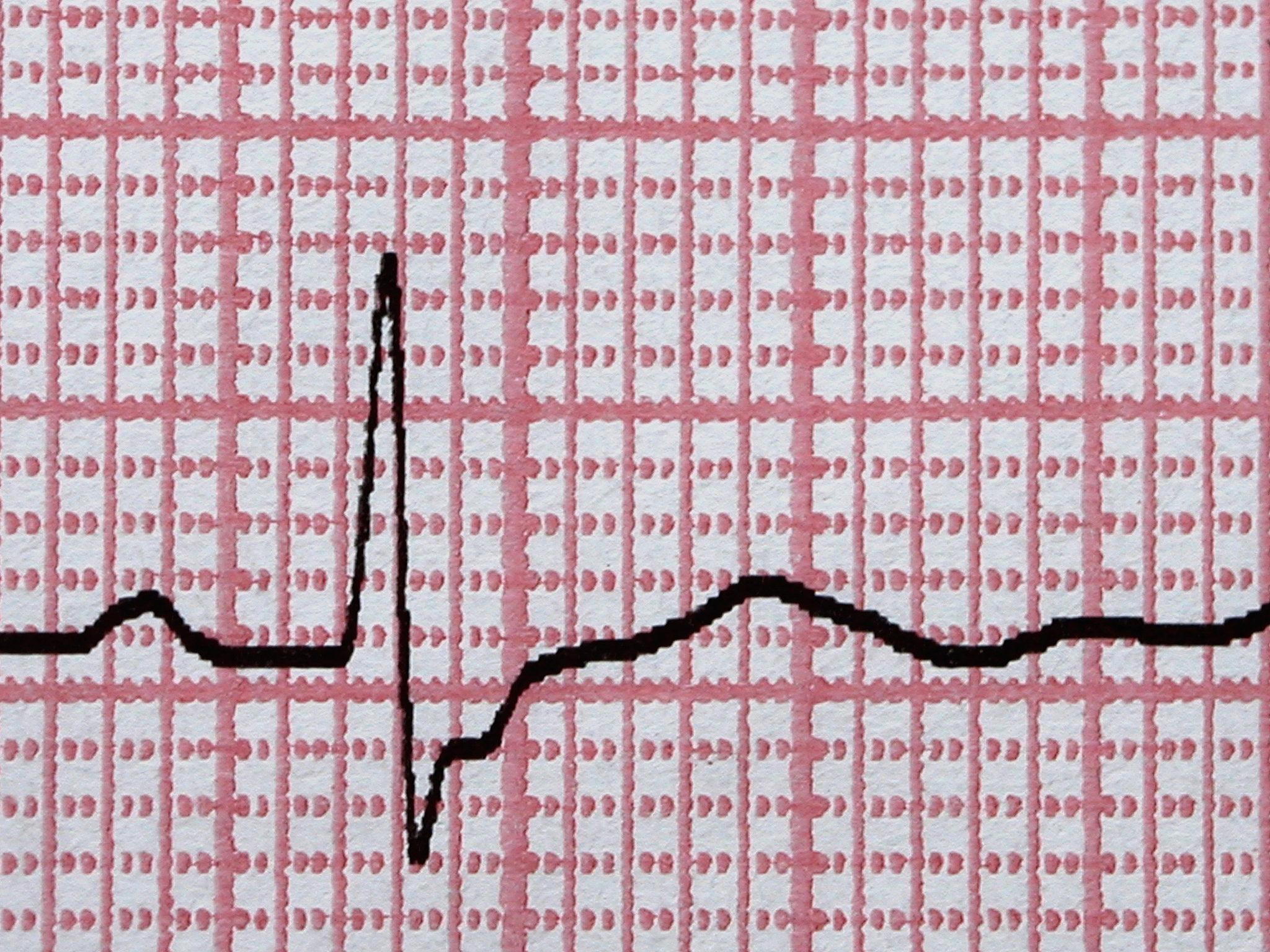 病态窦房结综合征：症状、诊断及鉴别方法