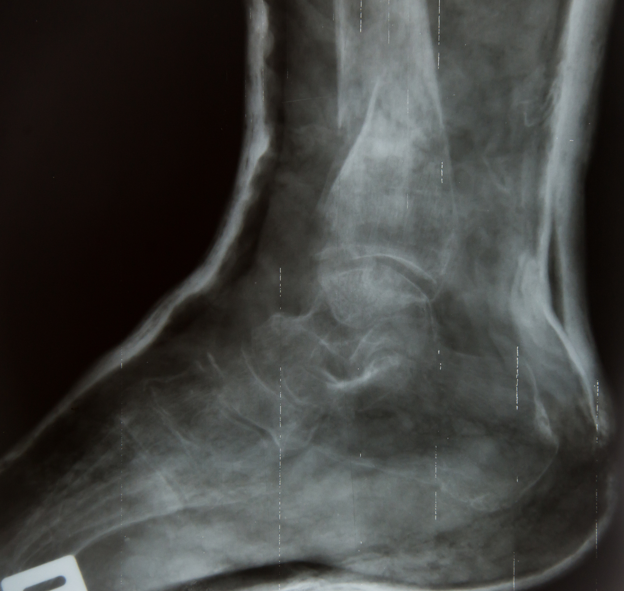 踝关节外侧副韧带复合体修复手术：预防继发性软骨损伤