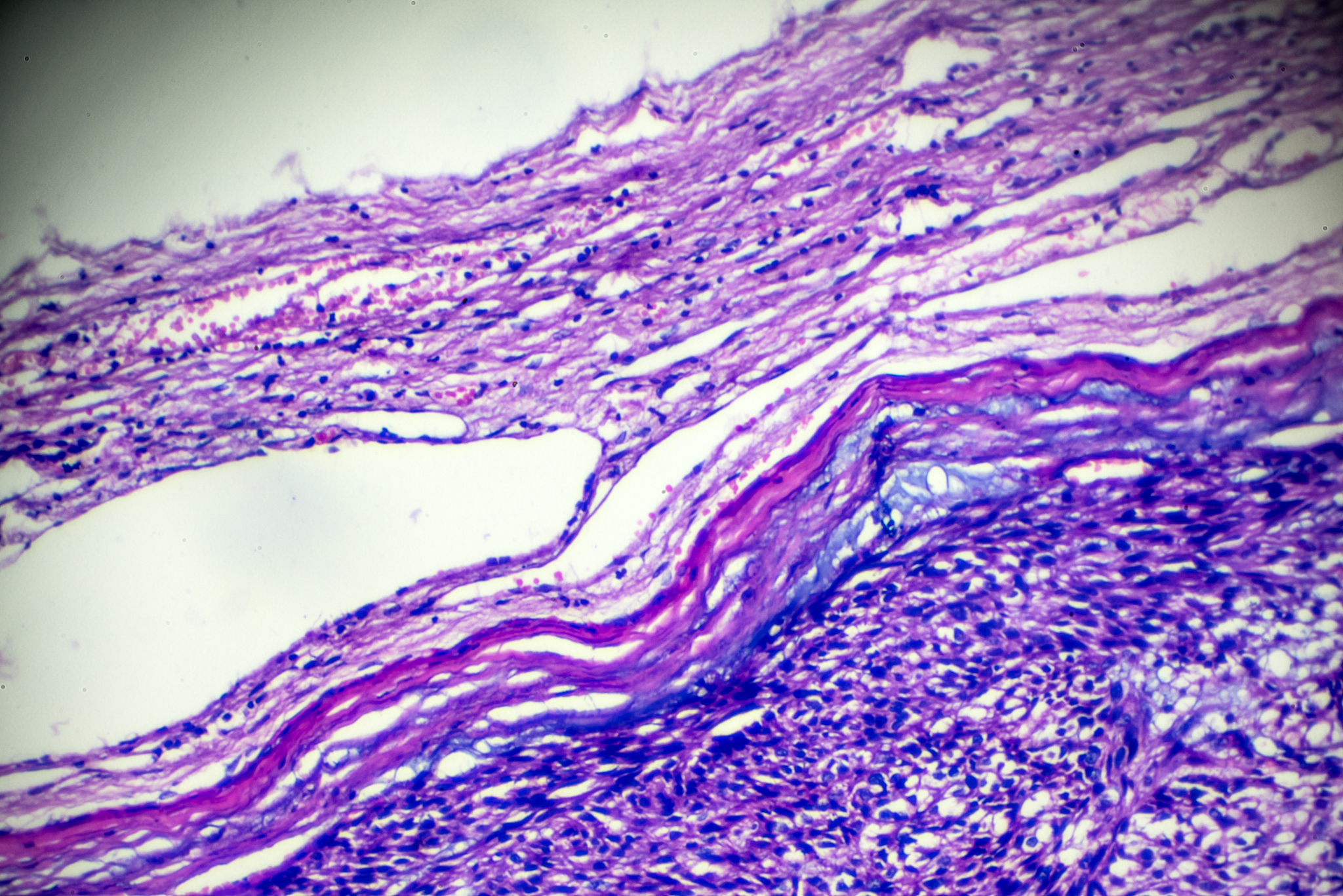 子宫肌瘤术后护理指南：预防感染、减轻疼痛、促进恢复