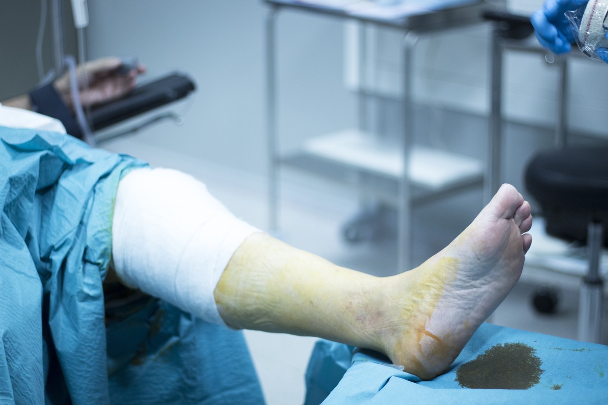 腓前韧带损伤治疗方法 - 休息、冷敷、压迫、抬高、支具、物理治疗、手术