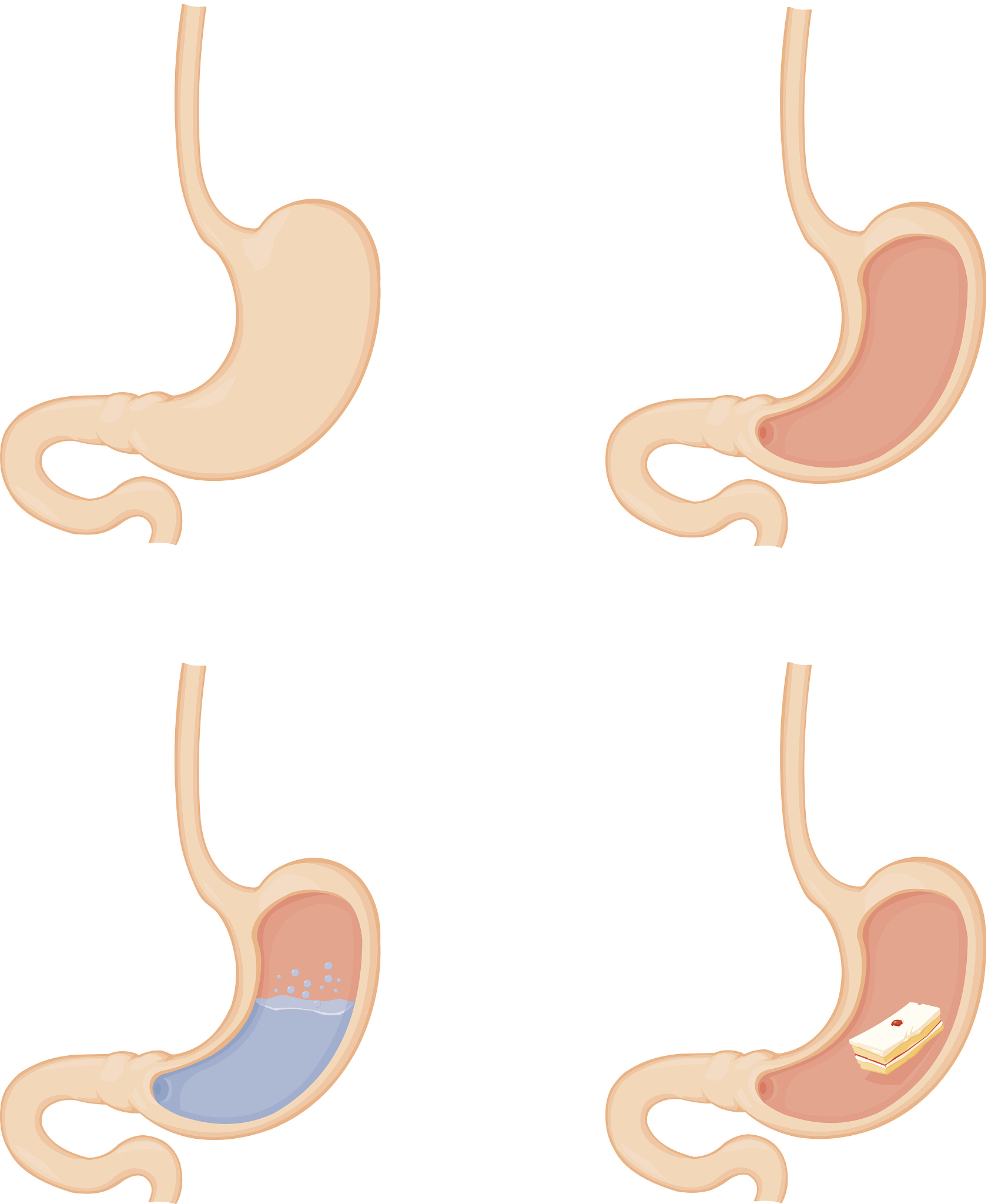 消化性溃疡与质子泵抑制剂