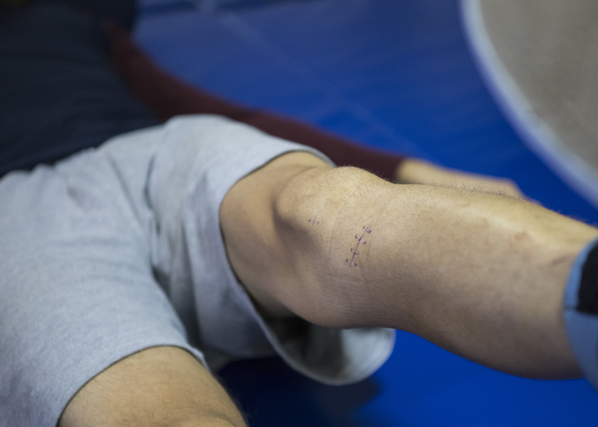 骨关节炎的治疗方法