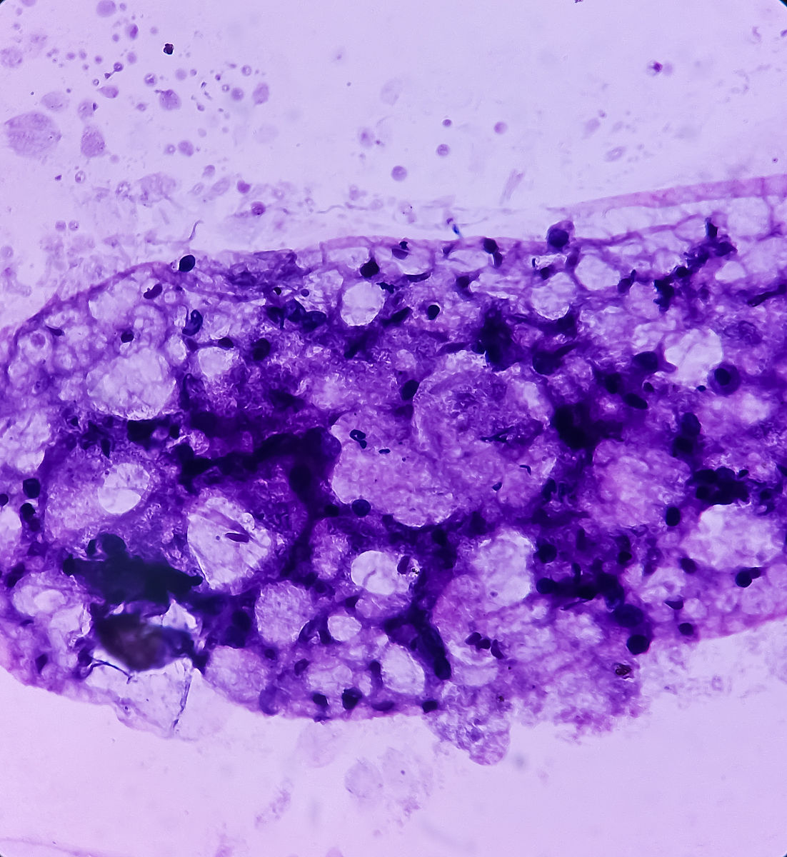 乳腺钼靶检查：良性与恶性肿块图像特征详解