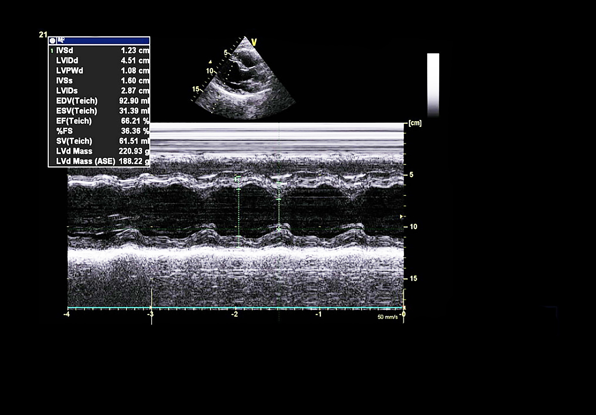 血管内超声诊断导管：提高换能器中心频率的必要性