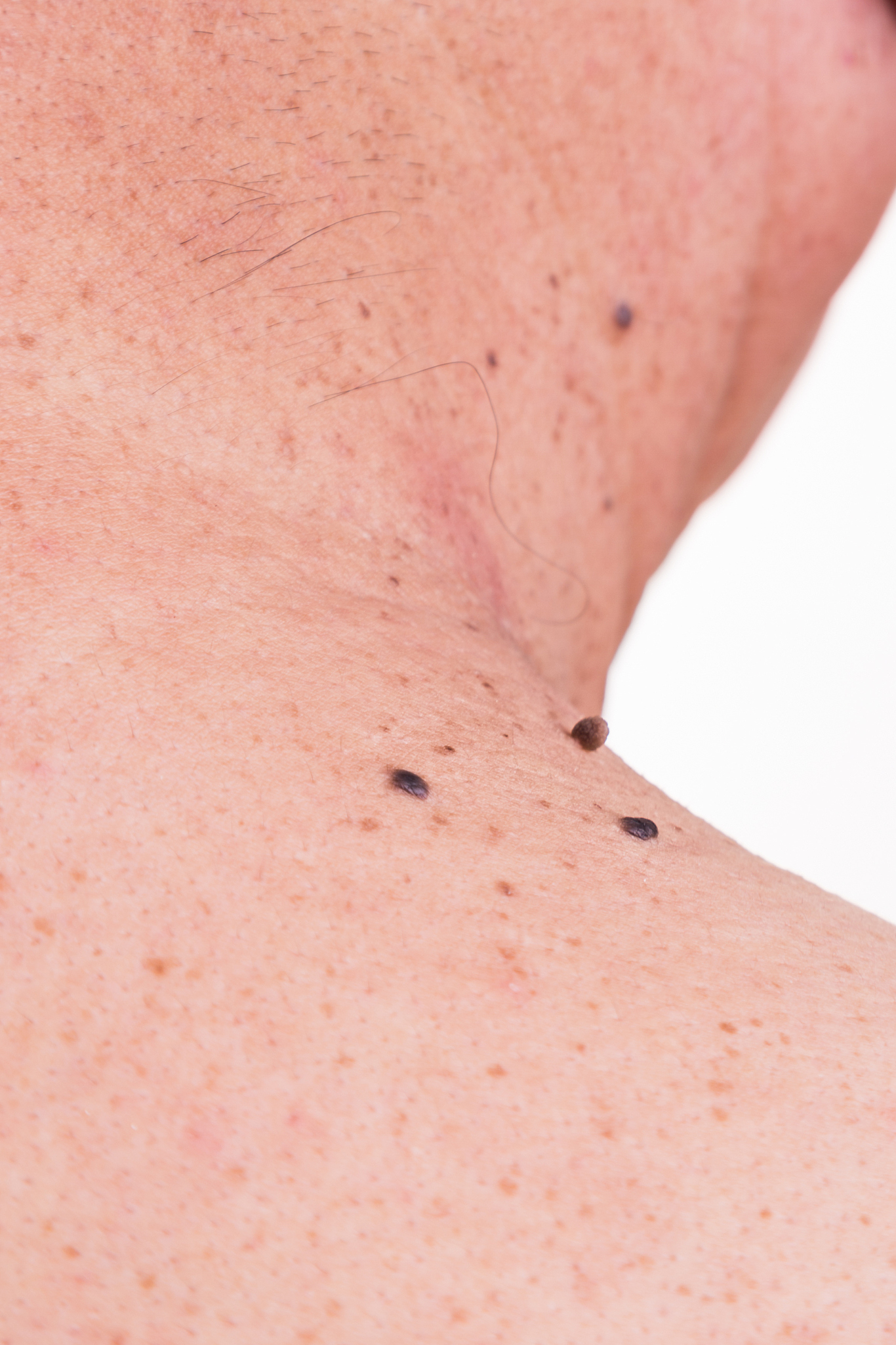 multiple mole on neck and shoulder of asian male