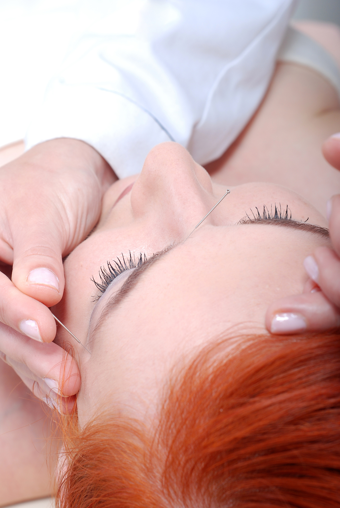 acupuncture
