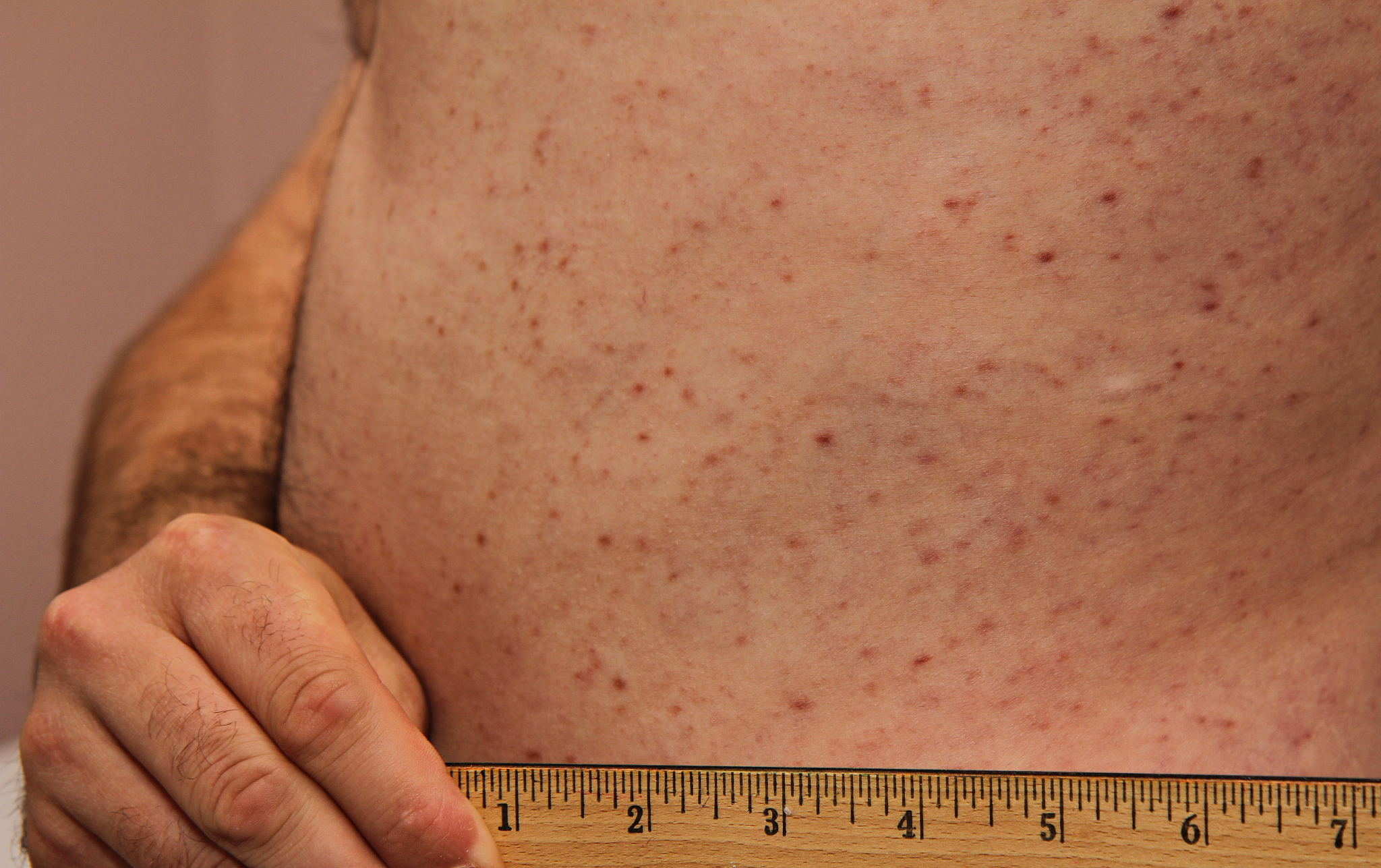 嗜碱性粒细胞白血病 (HES) 和肥大细胞白血病 (MCL) 鉴别诊断