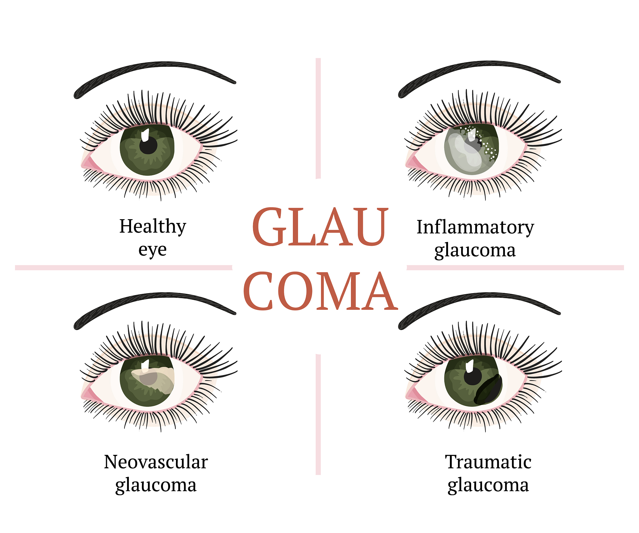 除了年龄、熬夜和遗传，眼袋还有哪些原因？