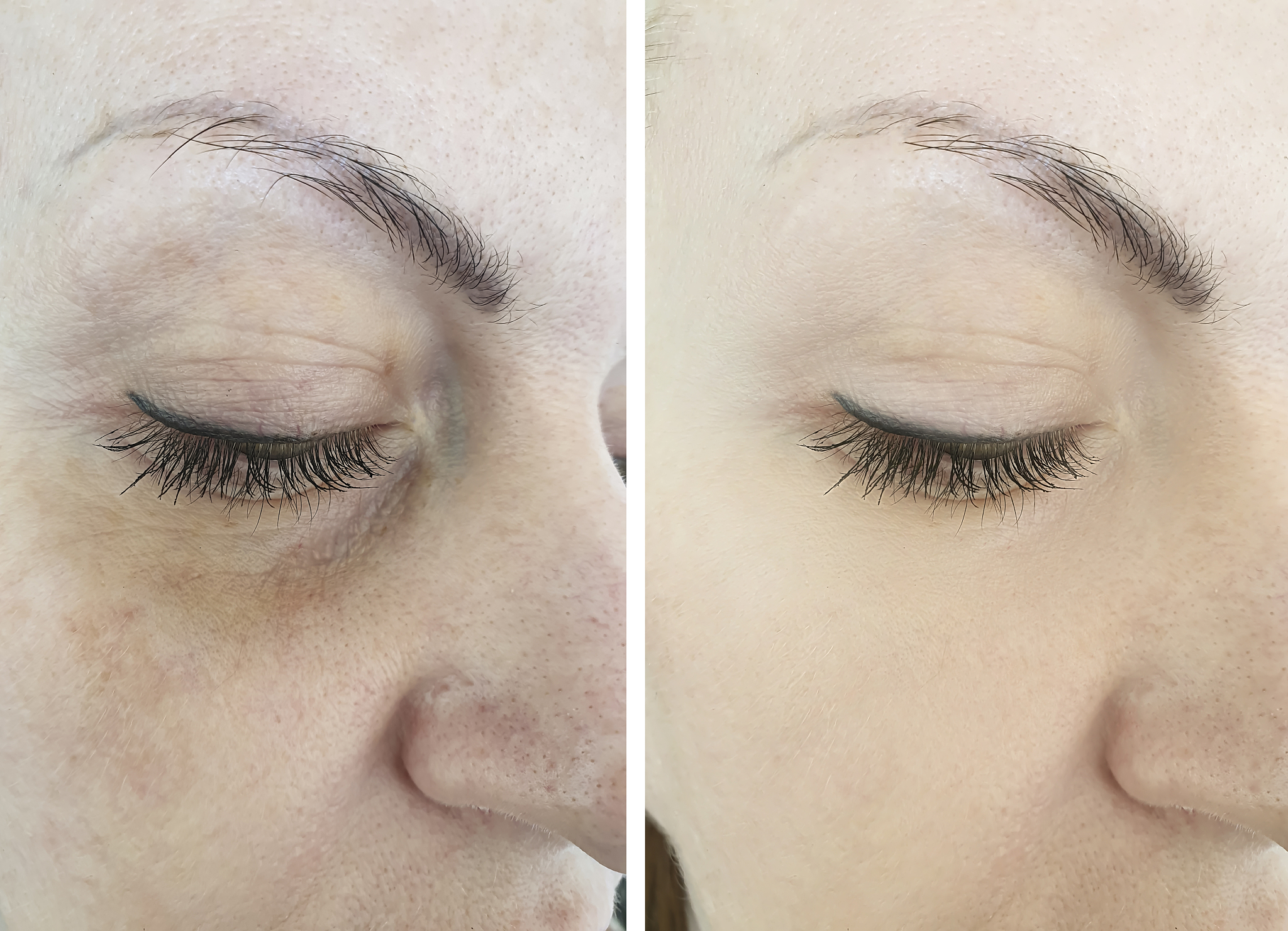 眼袋肿了怎么办