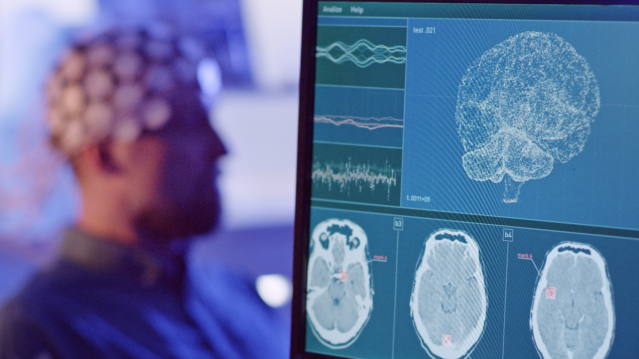 脑肿瘤切片识别概述