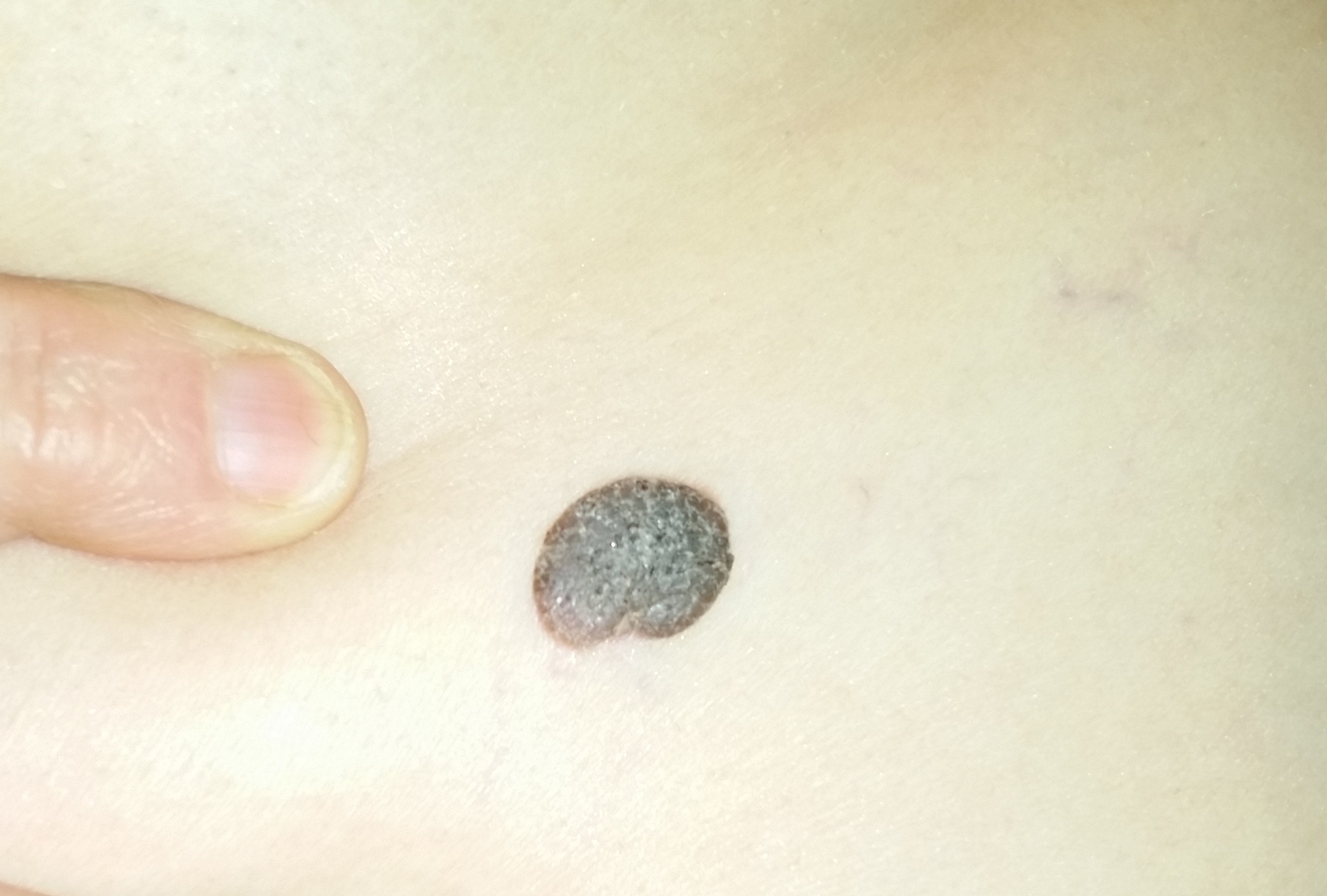 mole on skin