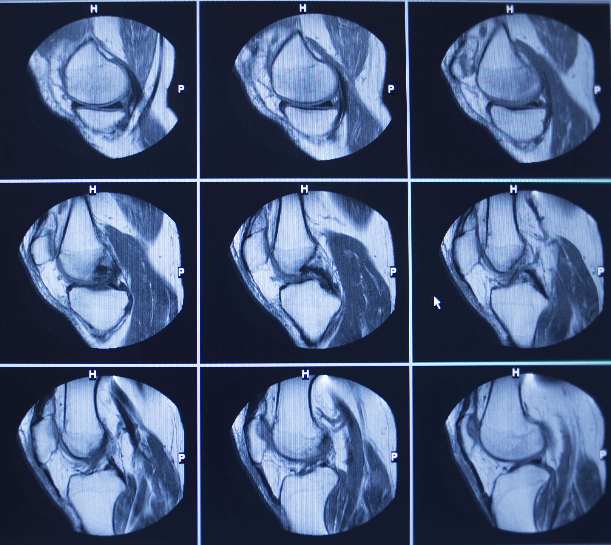 关节镜下前交叉韧带重建治疗消防员膝关节训练伤：有效性与安全性研究