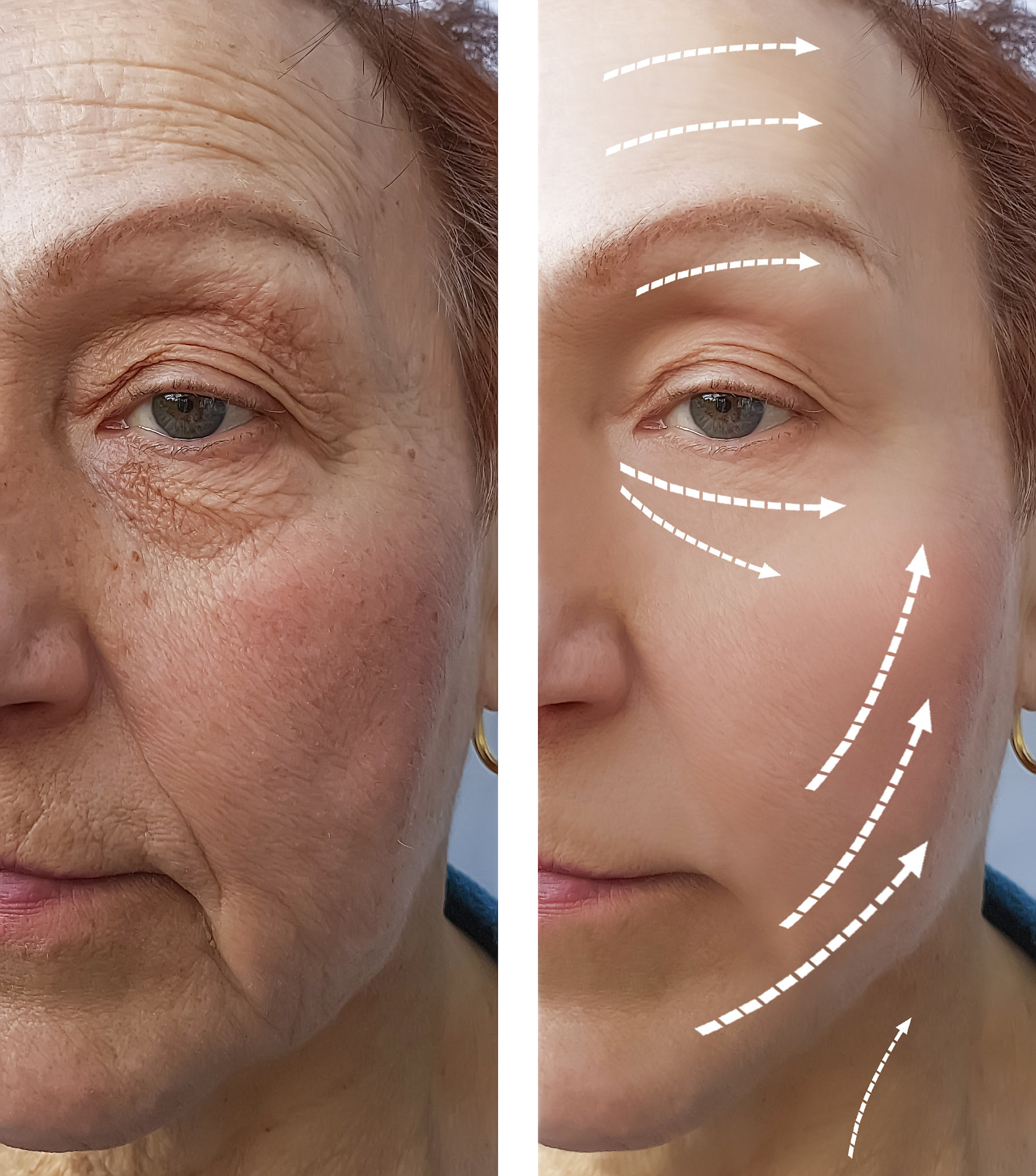 玻尿酸注射：改善皱纹、细纹、松弛的有效方法