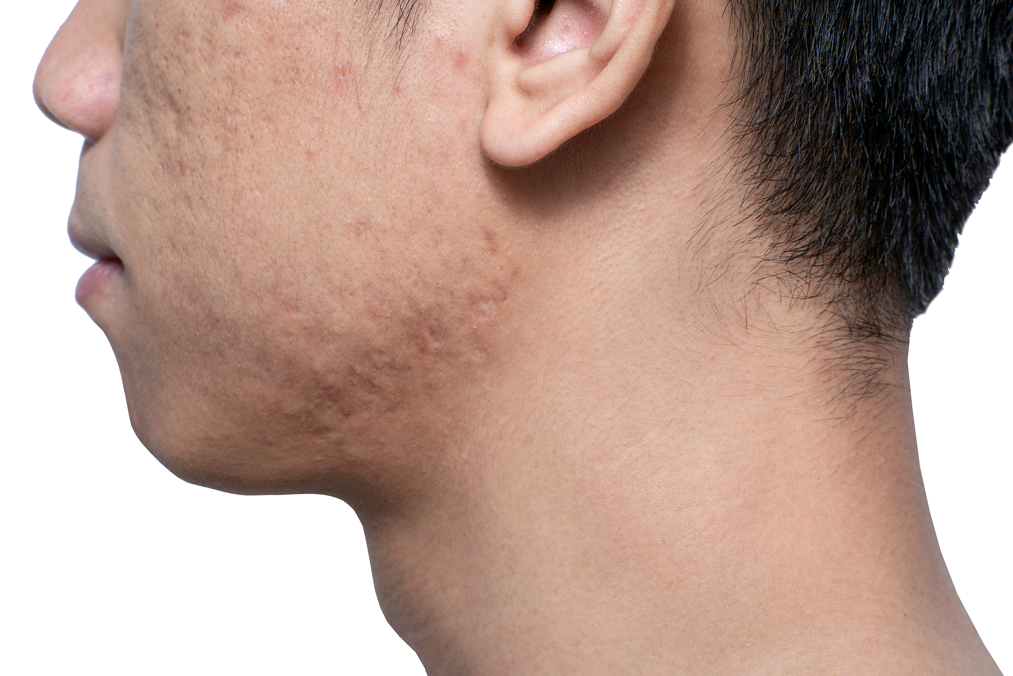 close-up acne and scars on asian man face