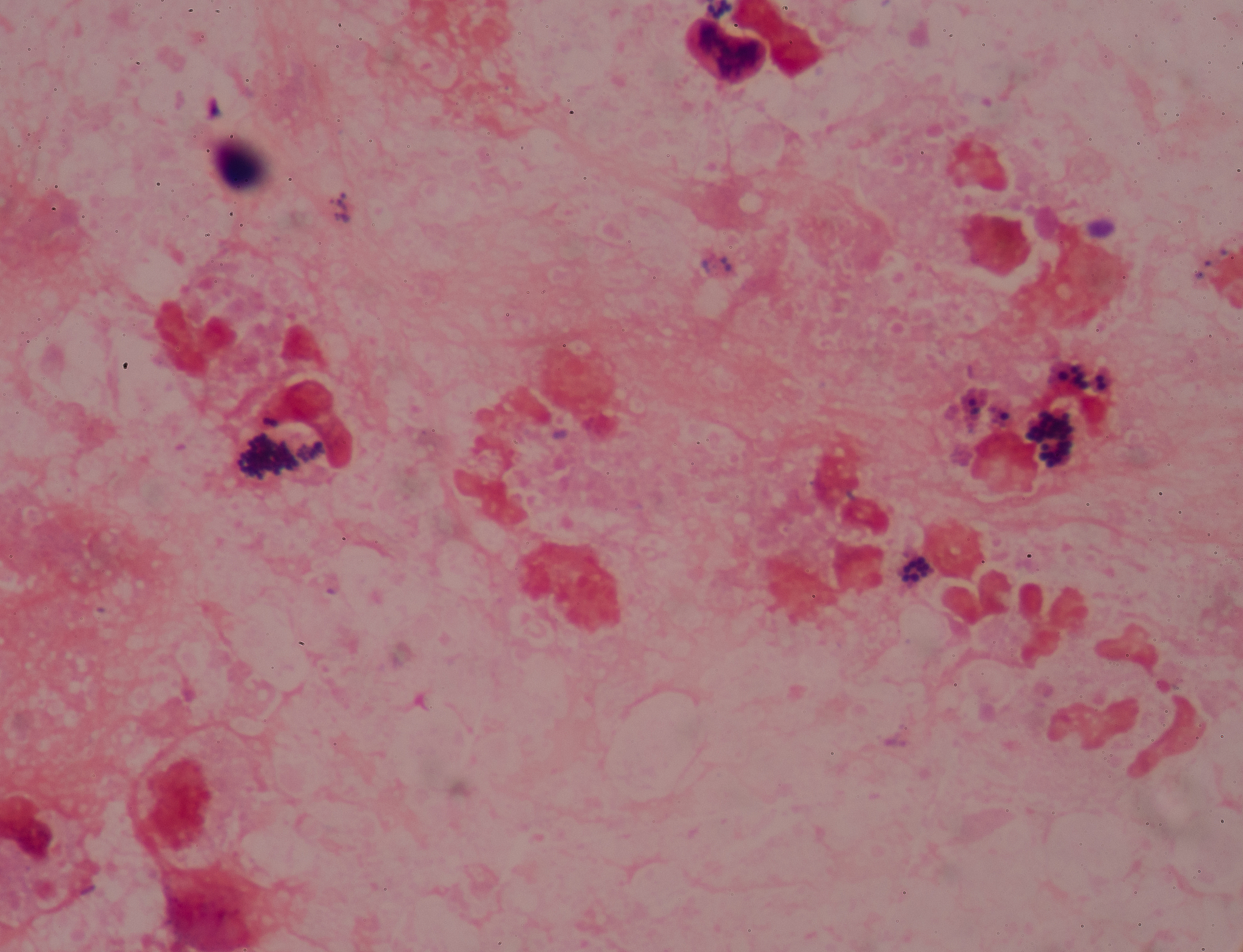 非特异性感染病变的演变可能有以下结果哪个选项除外A 炎症好转 B 局部化脓 C 全身抵抗力增强D 转为慢性炎症 E 炎症扩散