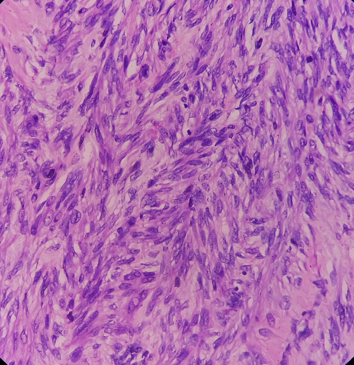 盆腔肿瘤和泌尿系统肿瘤科普：症状、检查、治疗和预防