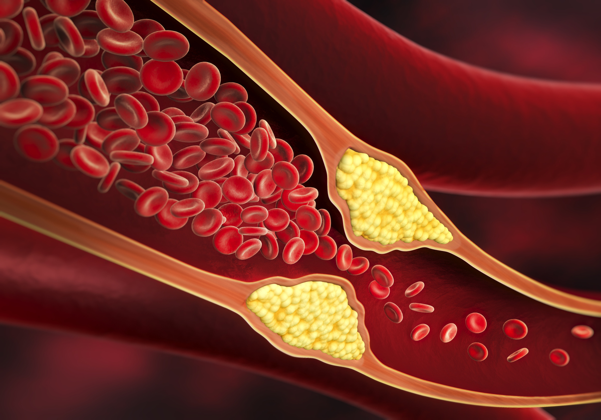 右侧颈动脉易损性斑块破裂：症状、治疗及预防