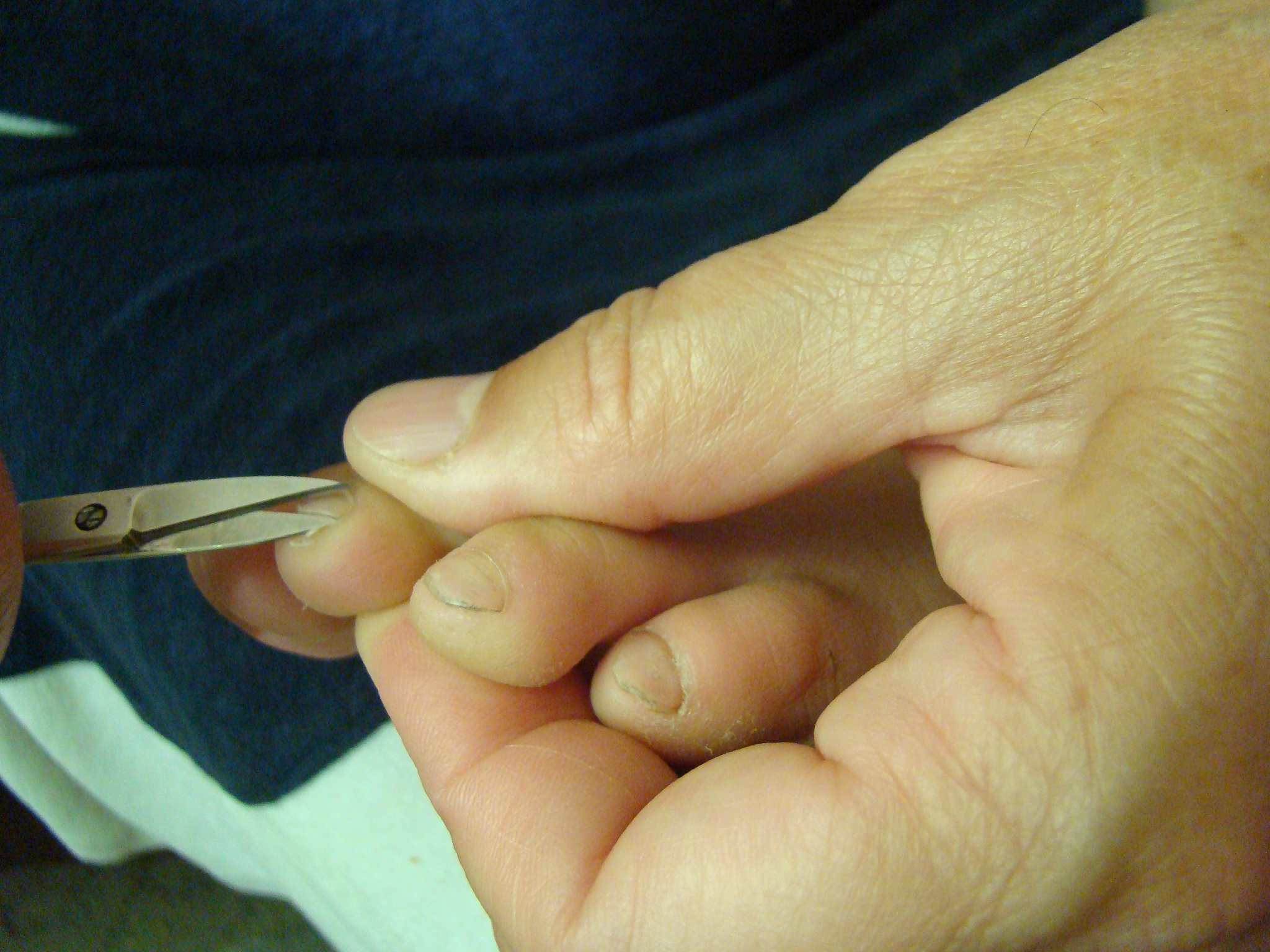 指甲往肉里长如何纠正? 指甲往肉里长如何纠正?