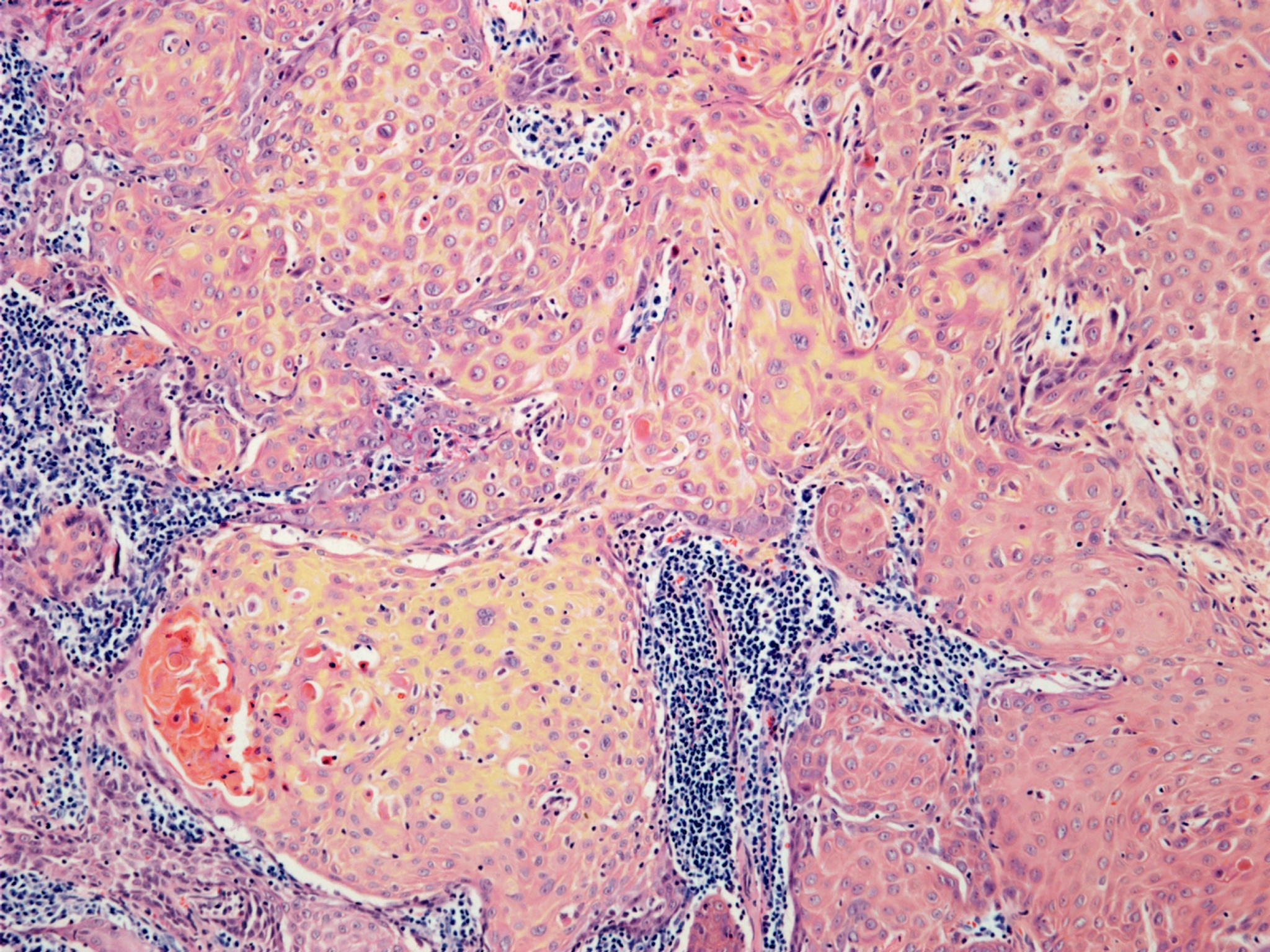 TCP病变：原因、表现及影响 - 全面解析