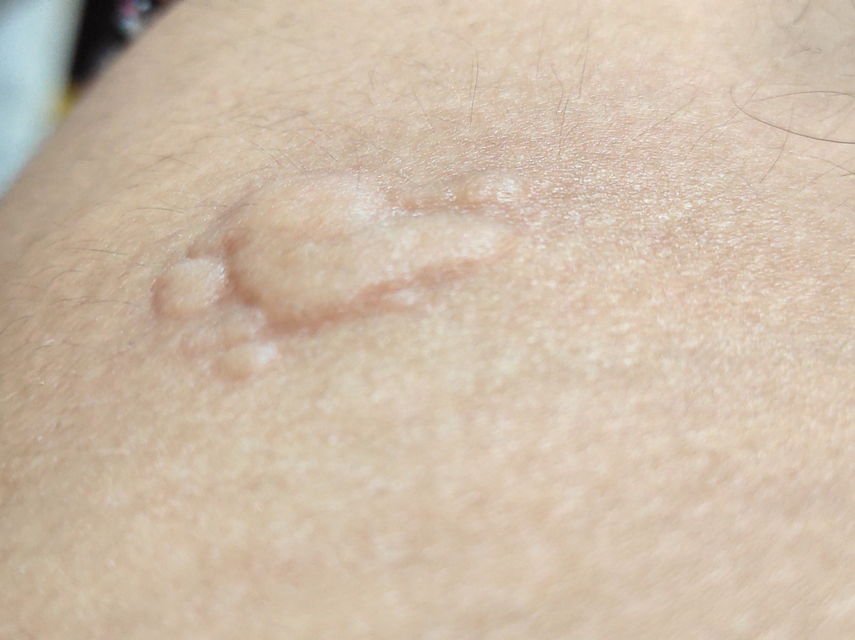 紫外线过敏为什么会起小疙瘩应该怎么处理