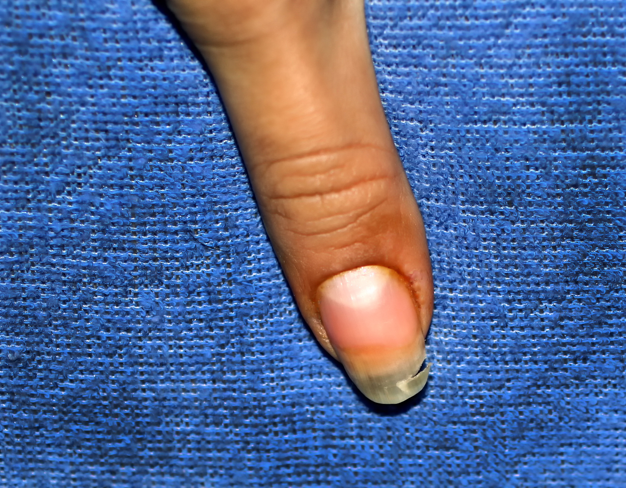 指甲出现白色横纹的原因 - 可能是这些原因！